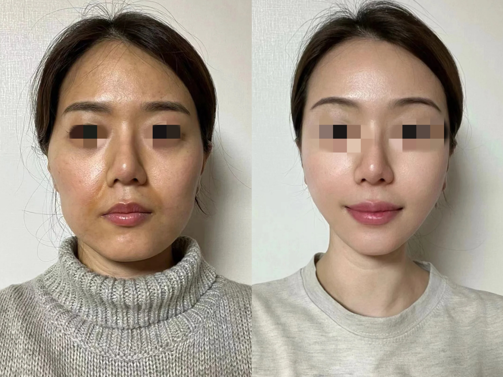做了无痕筋膜悬吊后3个月后,老公惊讶的看着我说:以后别瞎折腾了.