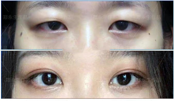 姑娘的眼睛天生有一些下垂,肿,一直以为是肿眼泡,也没去做过检查,其实