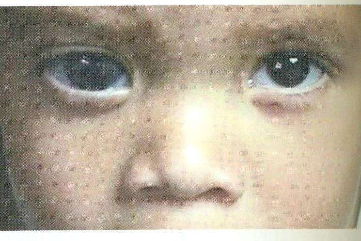 家长不可自作主张或在非兹肆僦涨 瞳孔散大图片瞳孔散大图片散瞳做完