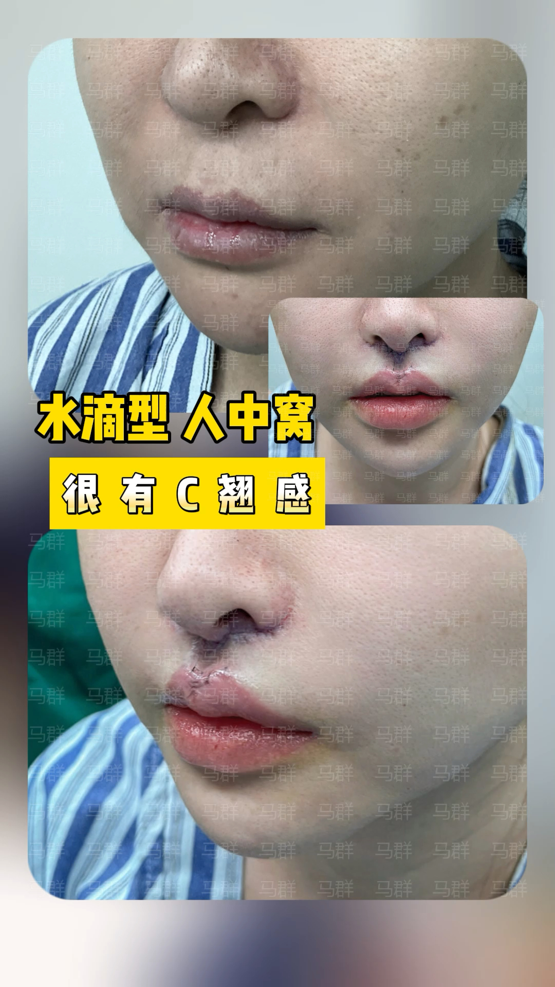 水滴形人中和直线型人中哪个更好看?