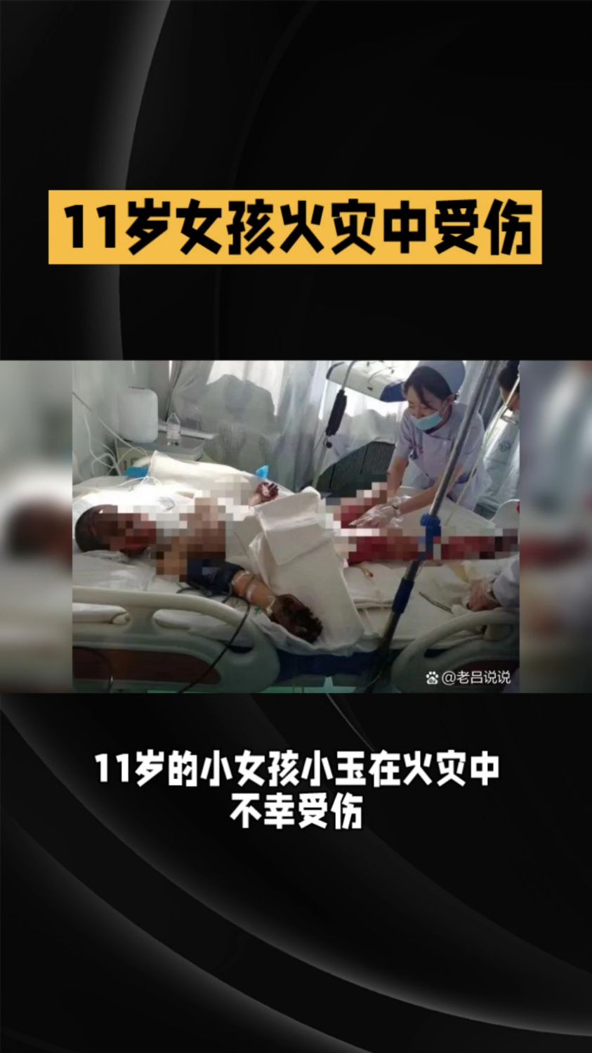 11岁小女孩在火灾中被烧成重伤-度小视