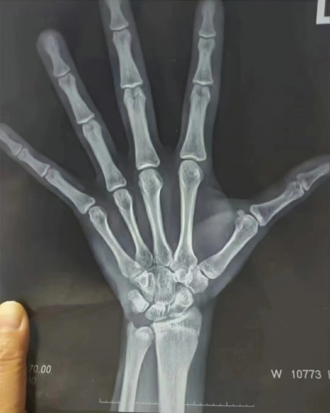 孩子的骨龄发育不容忽视骨骺线闭合就意味着孩子再无长高空间所以