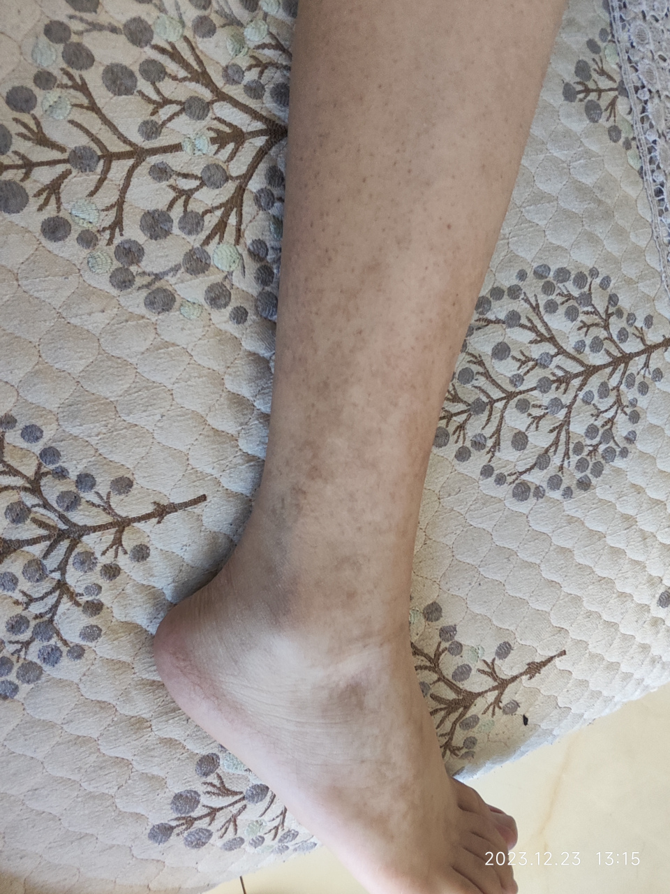 14岁男孩,色素紫癜8个月,反复皮肤紫癜在两小腿和两脚,没有身体彩适