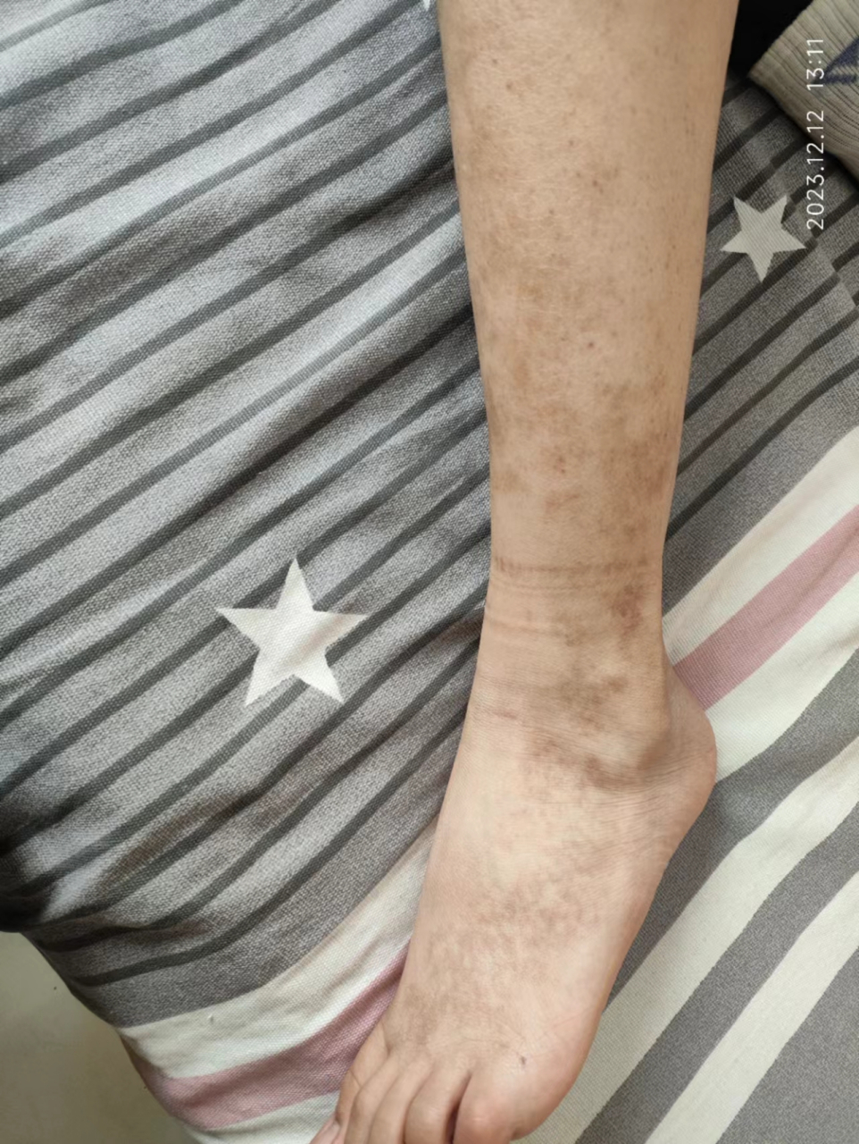 14岁男孩,色素紫癜8个月,反复皮肤紫癜在两小腿和两脚,没有身体不适