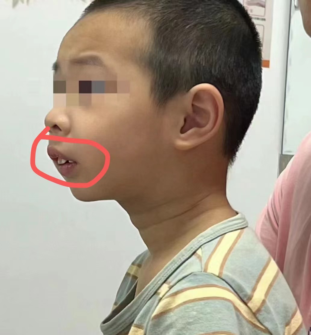孩子出现腺样体面容前的6个信号,家长自查
