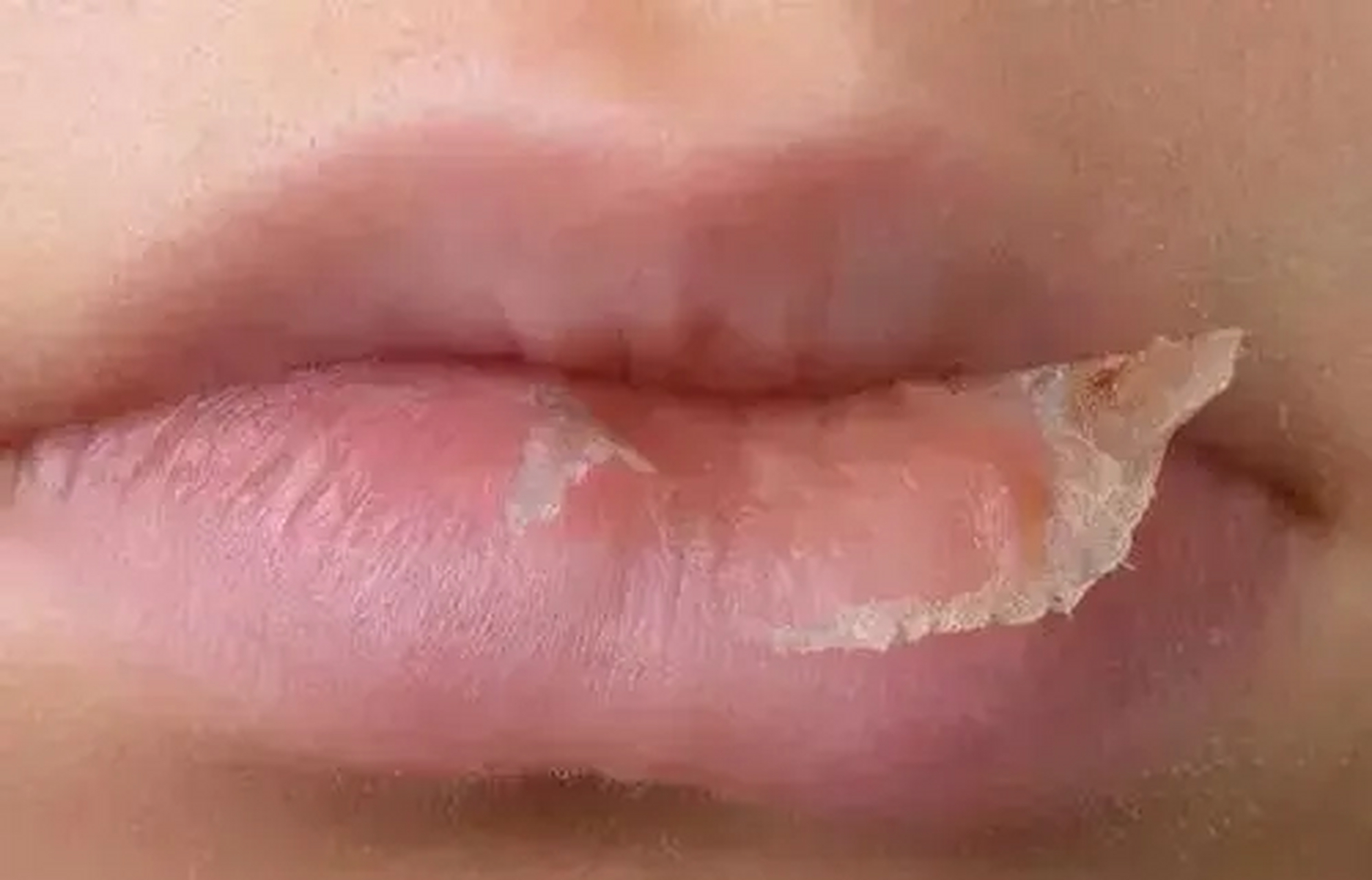 如果你发现你的孩子的嘴唇时常干燥并开始起皮,即使多喝水也不能