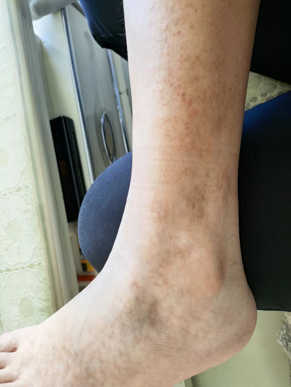 14岁男孩,色素紫癜8个月,反复皮肤紫癜在两小腿和两脚,没有身体彩适