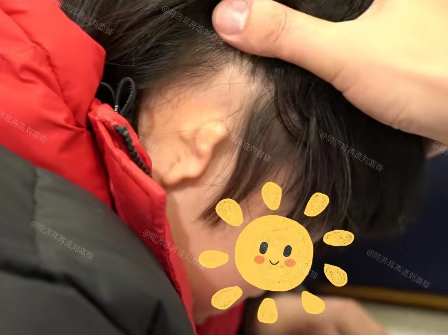 这个小男孩的耳朵"扭"在了一起,耳道闭锁,只有一条小肉.
