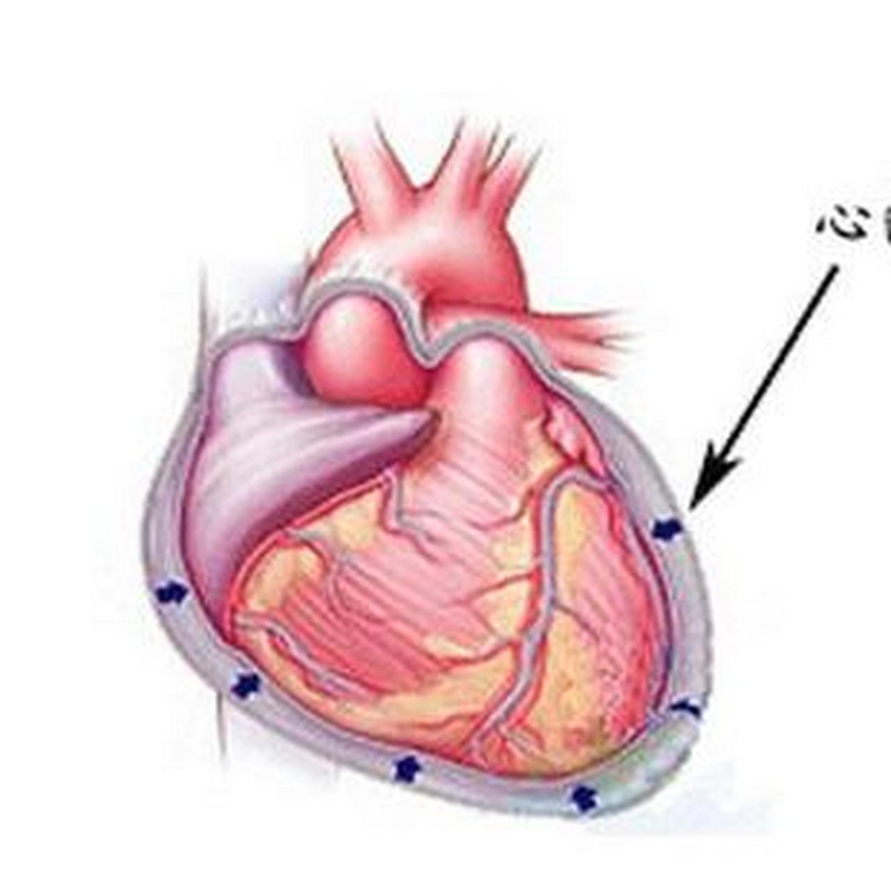 心包积液图解图片