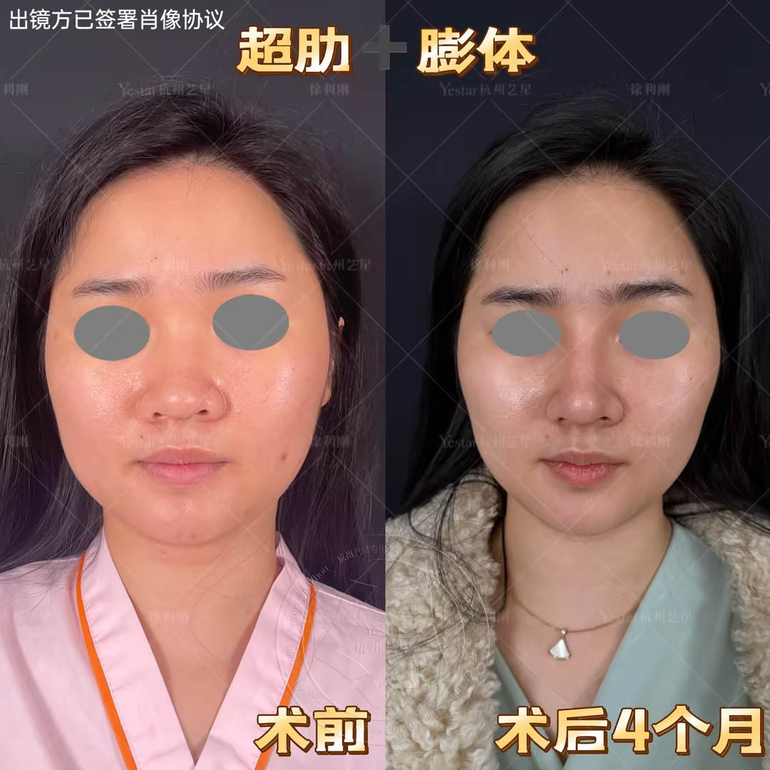 超肋术后4个月 #徐利刚鼻综合