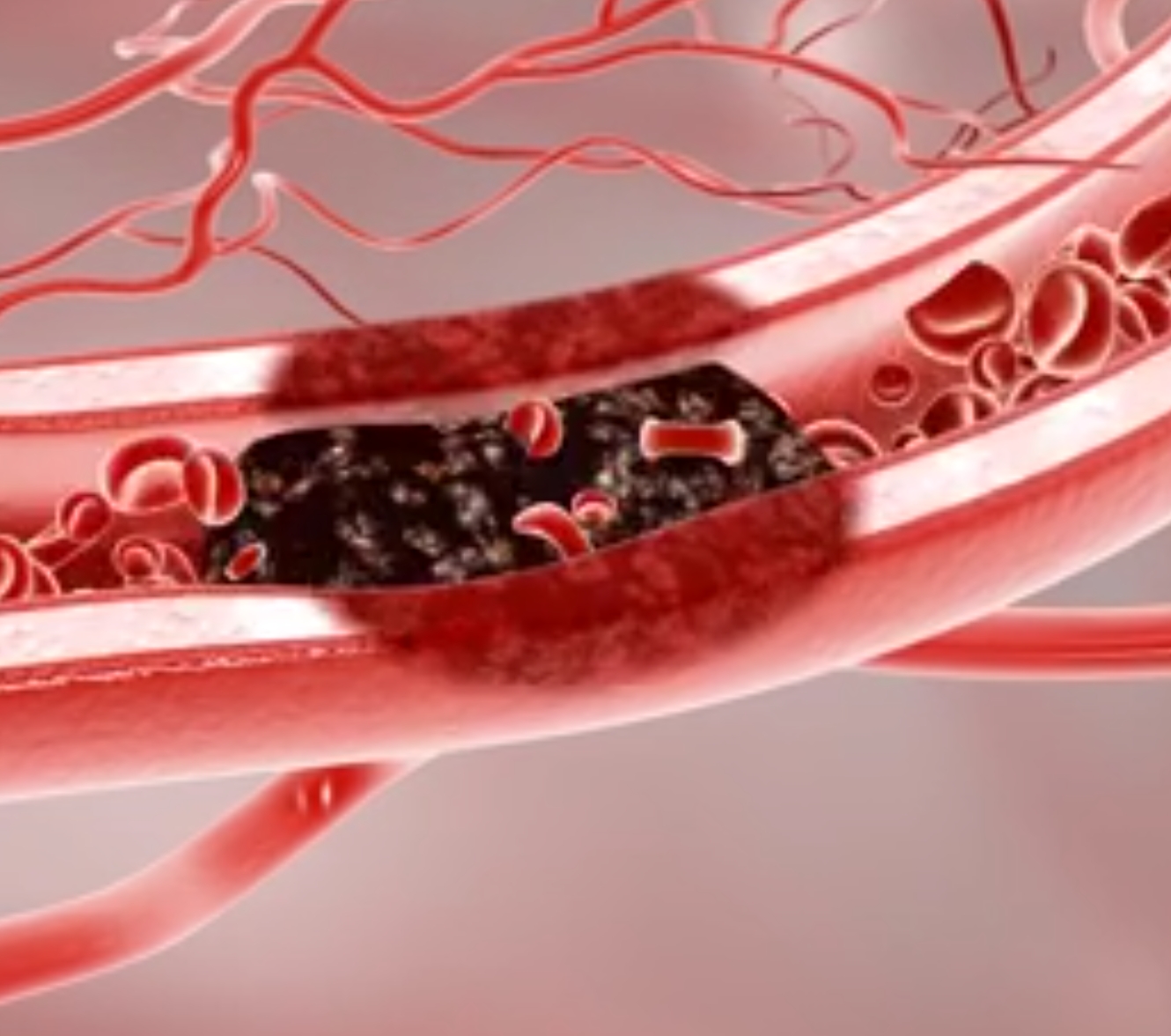 导致脑梗急性发作的风险,那么被称为"血管垃圾"的斑块怎样才能缩小?