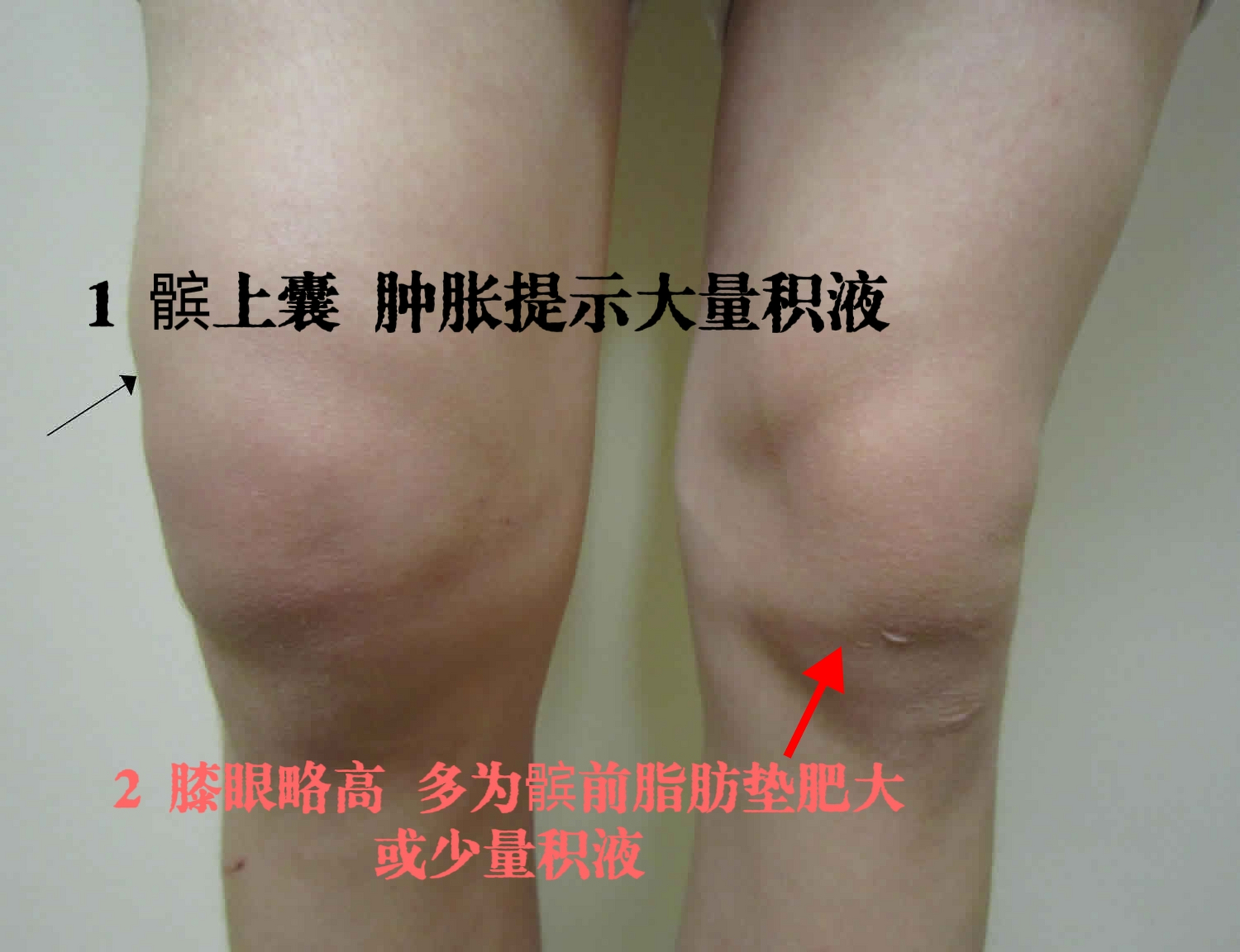 今天来了一位大姐,一进诊室就提出了诉求"大夫,我关节有积液,我要