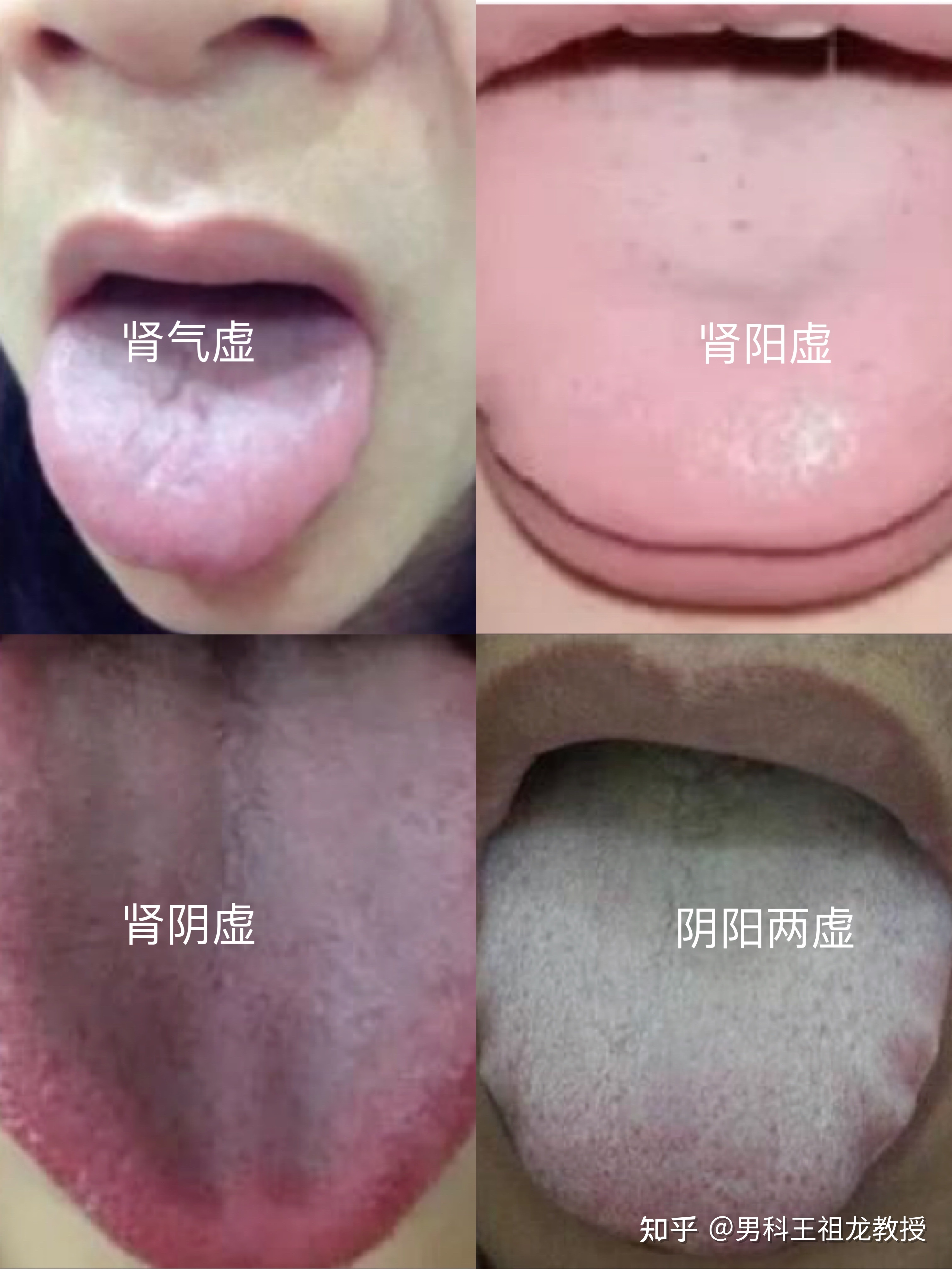 肾阴虚和肾阳虚的区别