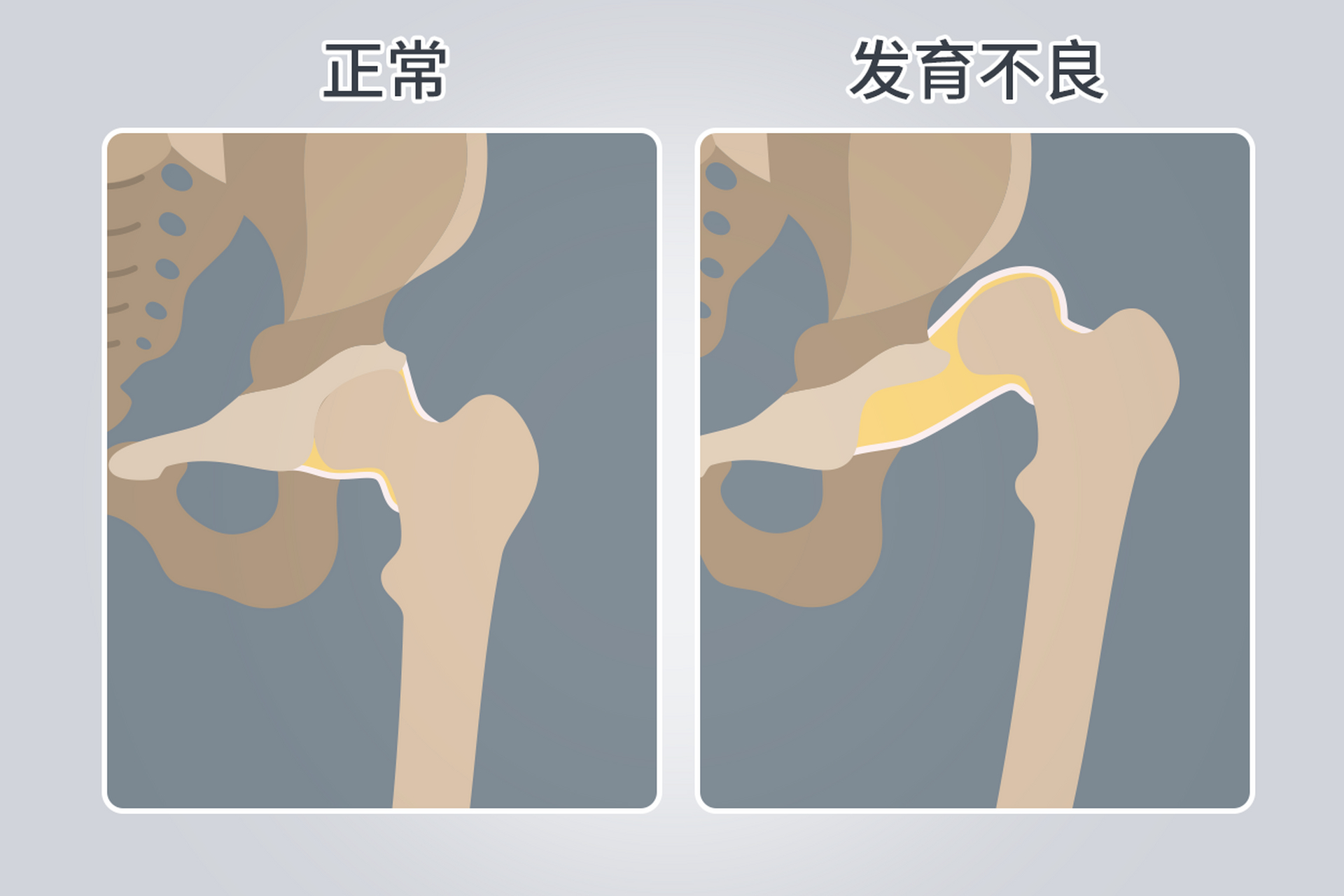 小儿髋关节脱位# #合肥小儿髋关节脱位医院# #髋关节脱位#  #安徽