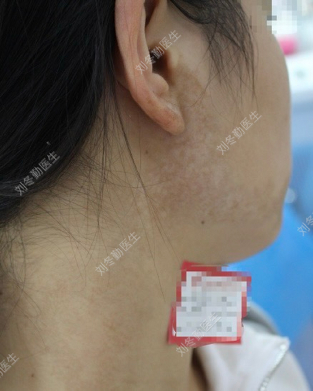 女孩下颌长有大片褐色胎记,原来是长了这种怪痣  这位女孩下颌的咖啡