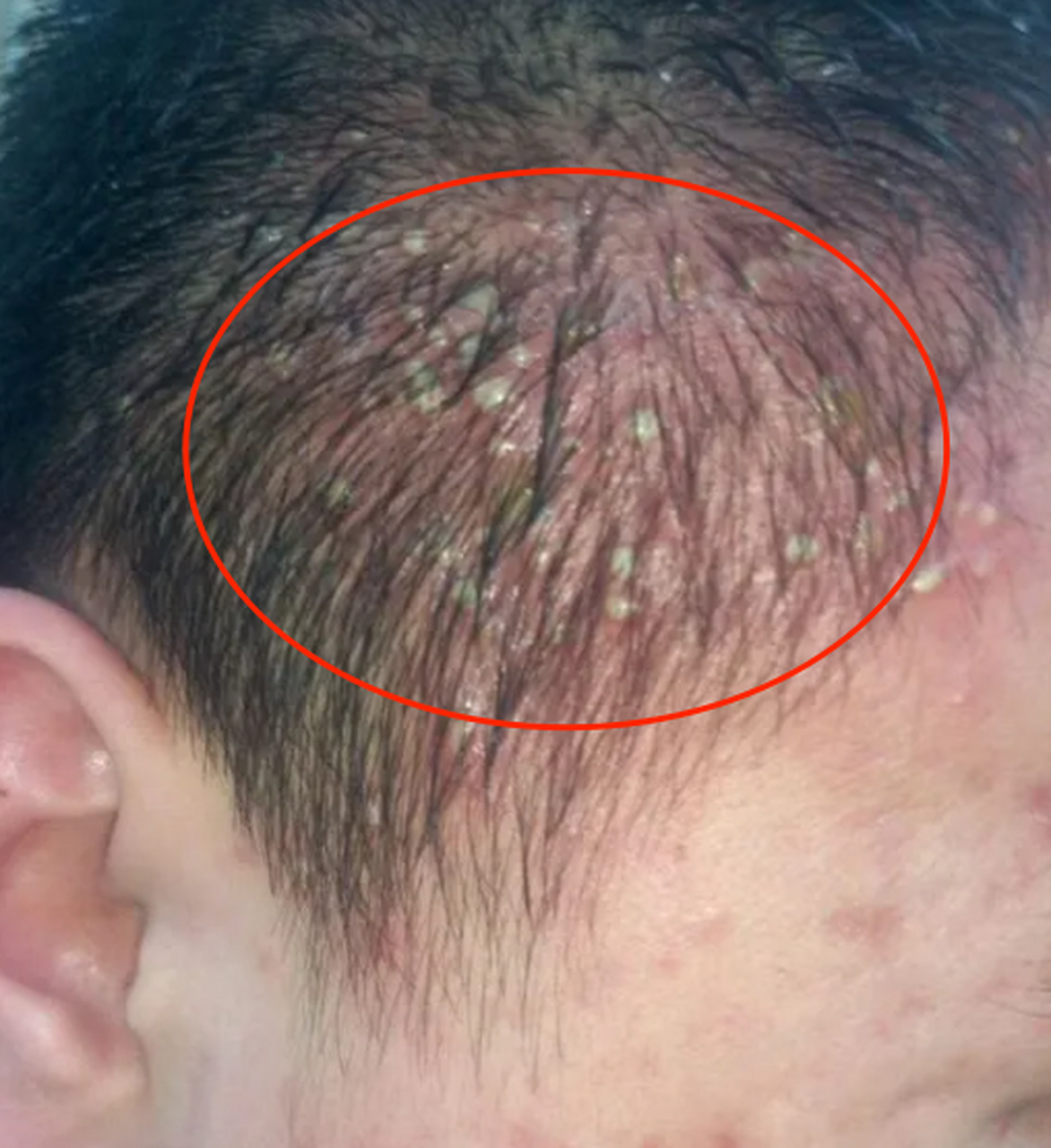 头上出现红疙瘩,脓包,疼痛瘙痒,是毛囊炎的征兆吗?