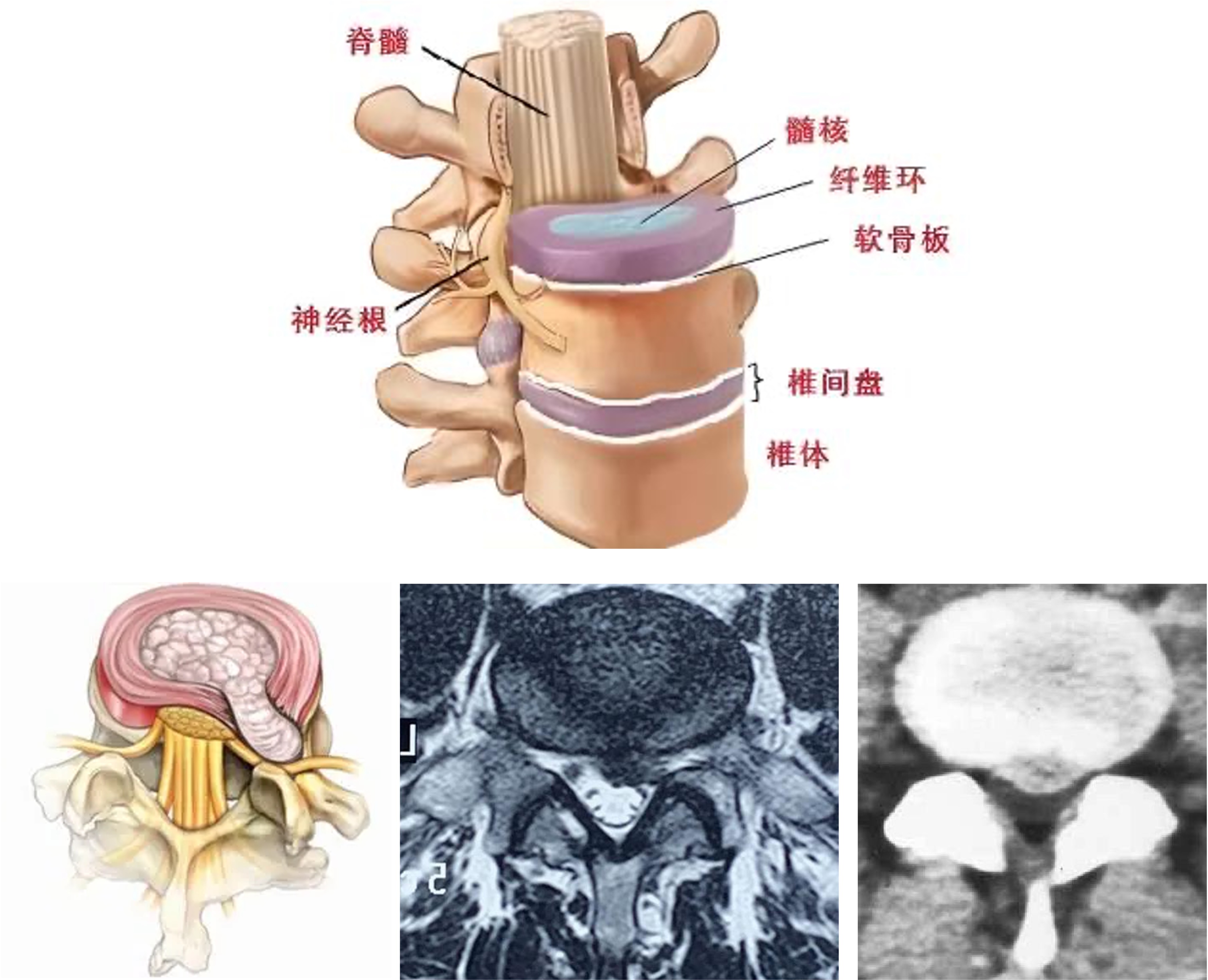 聊一聊椎间盘的结构