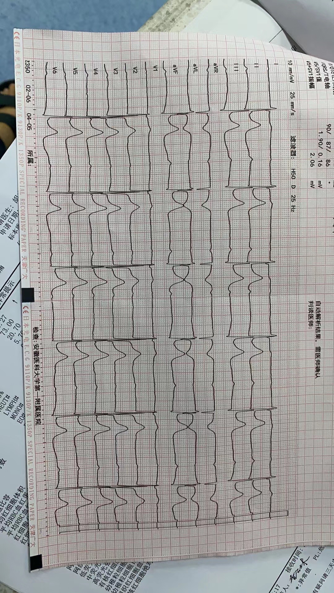 起搏器心律心电图报告图片
