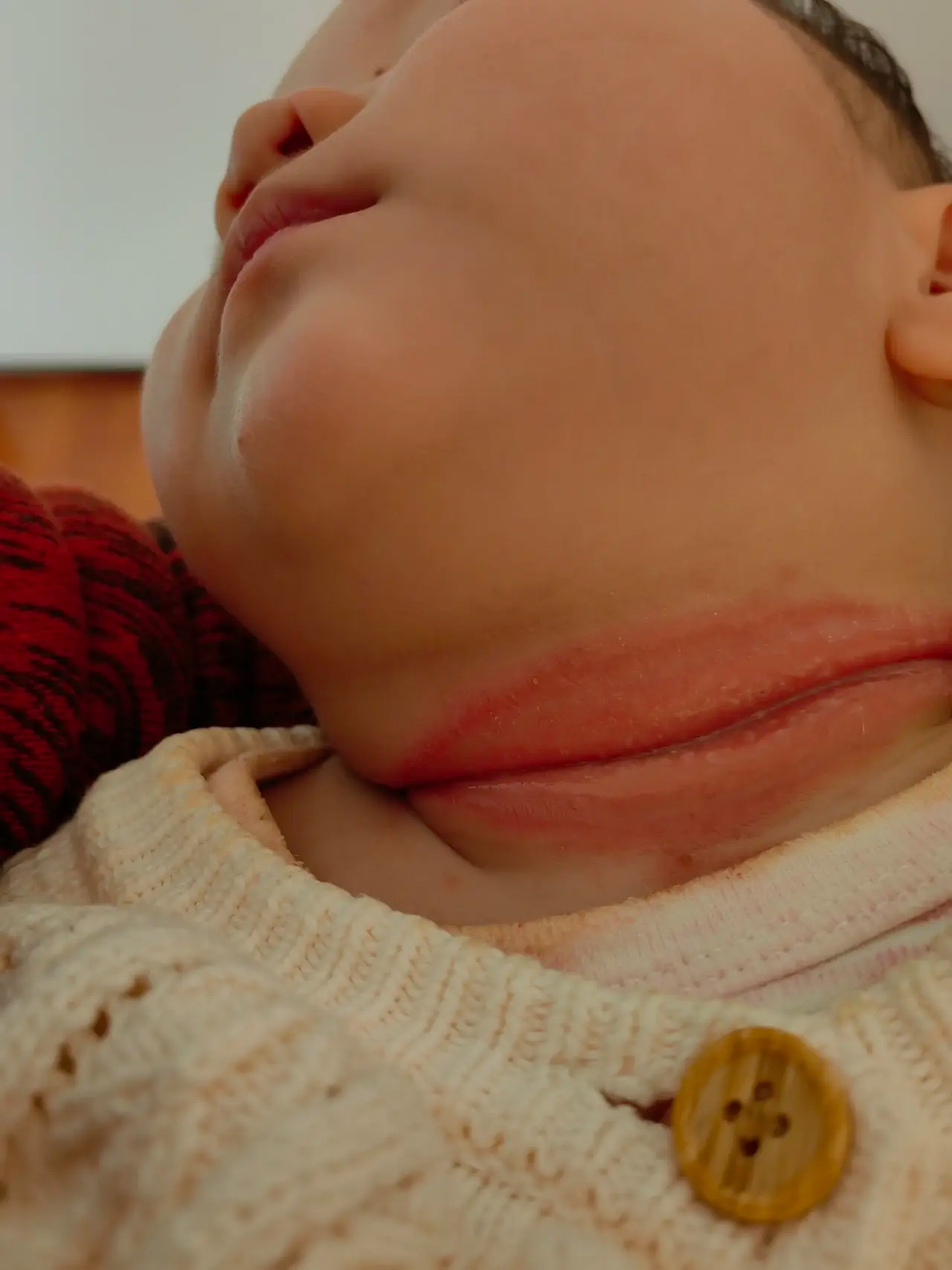 求助各位有没有什么好的妙招啊,有什么药膏可以治好这个呢?