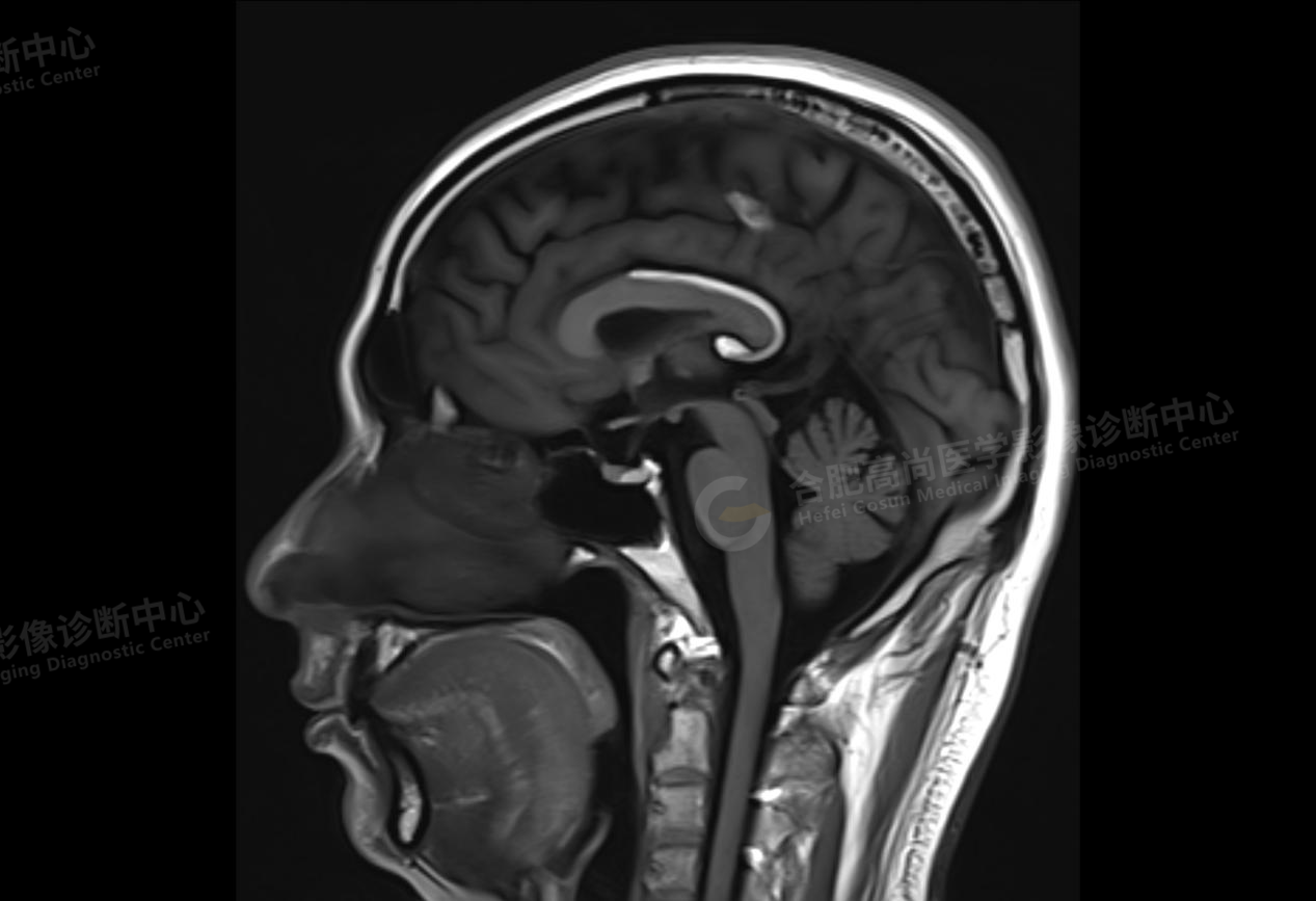 小脑蚓部脂肪瘤图片