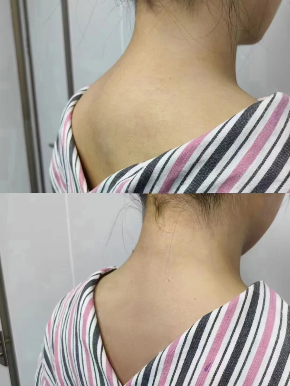 【王女士富贵包快乐消除术|即刻对比案例分享】 巨大富贵包,除了外形