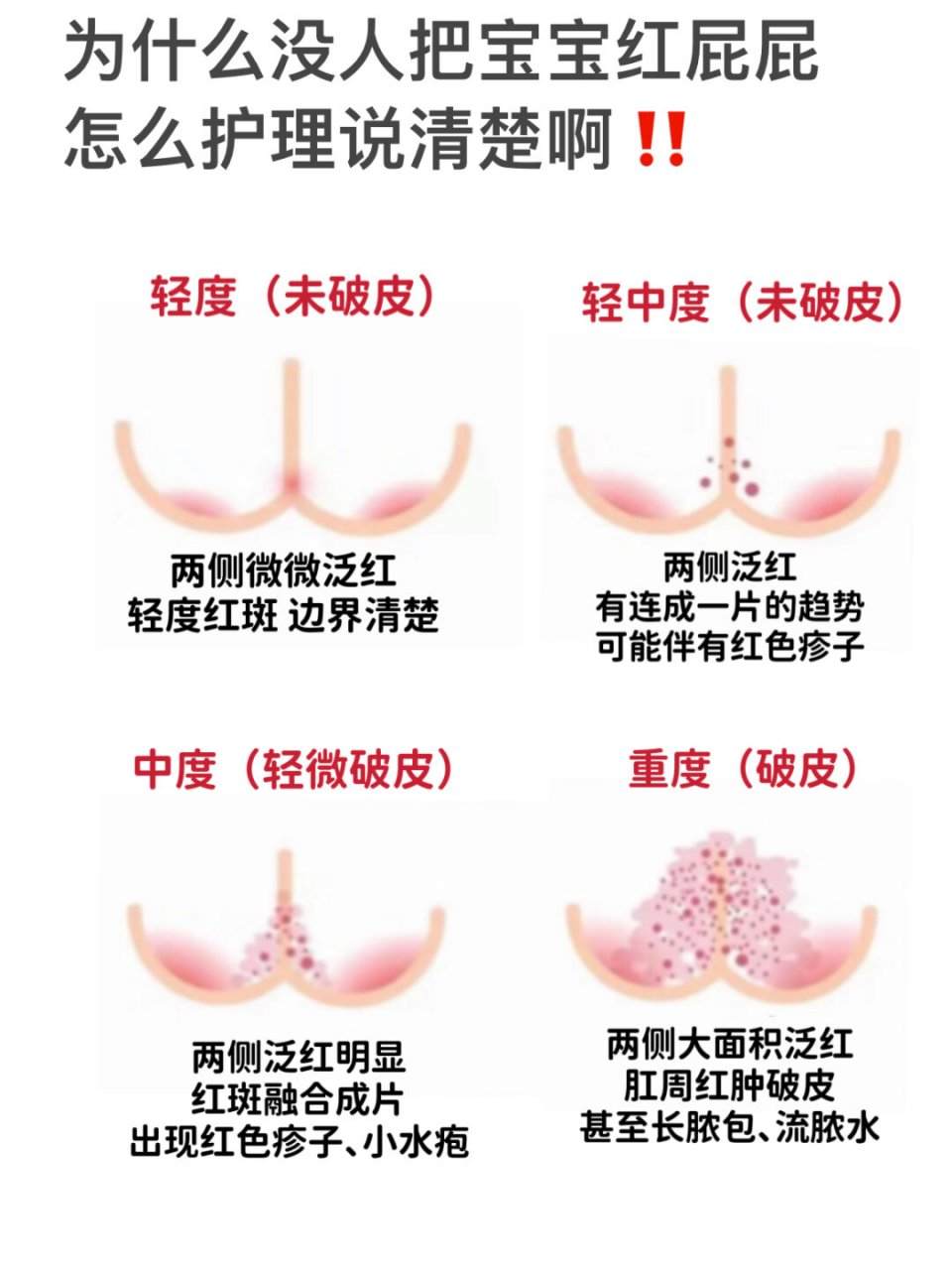 我家宝宝在月子里因为纯母乳便便次数多,红屁屁特别严重