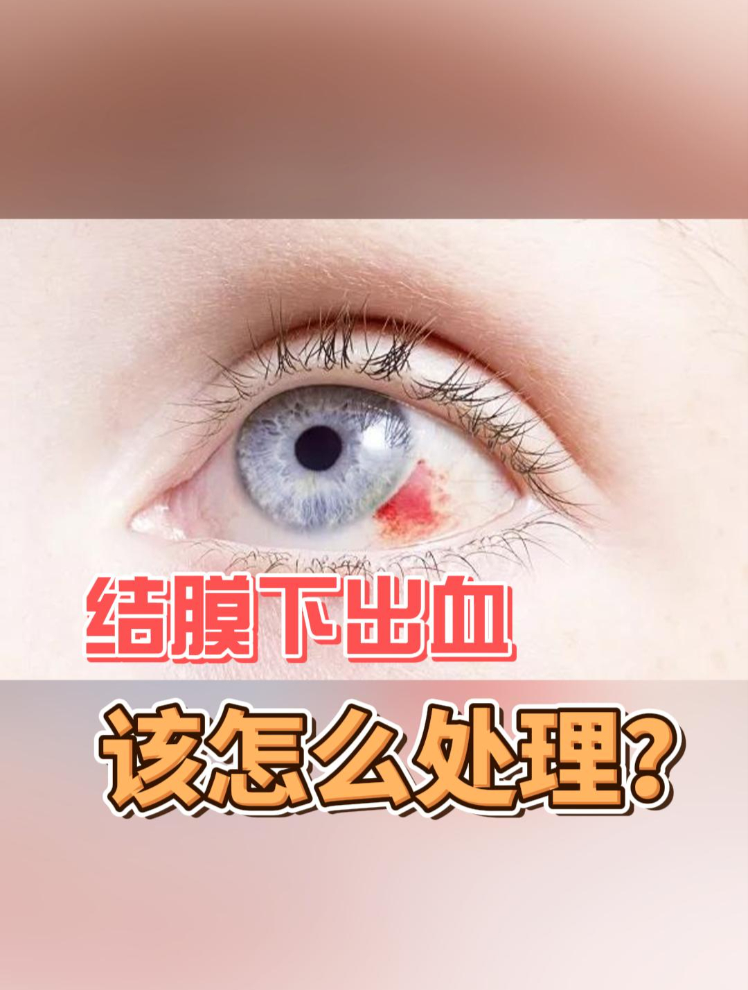 眼睛红血块怎么回事图片