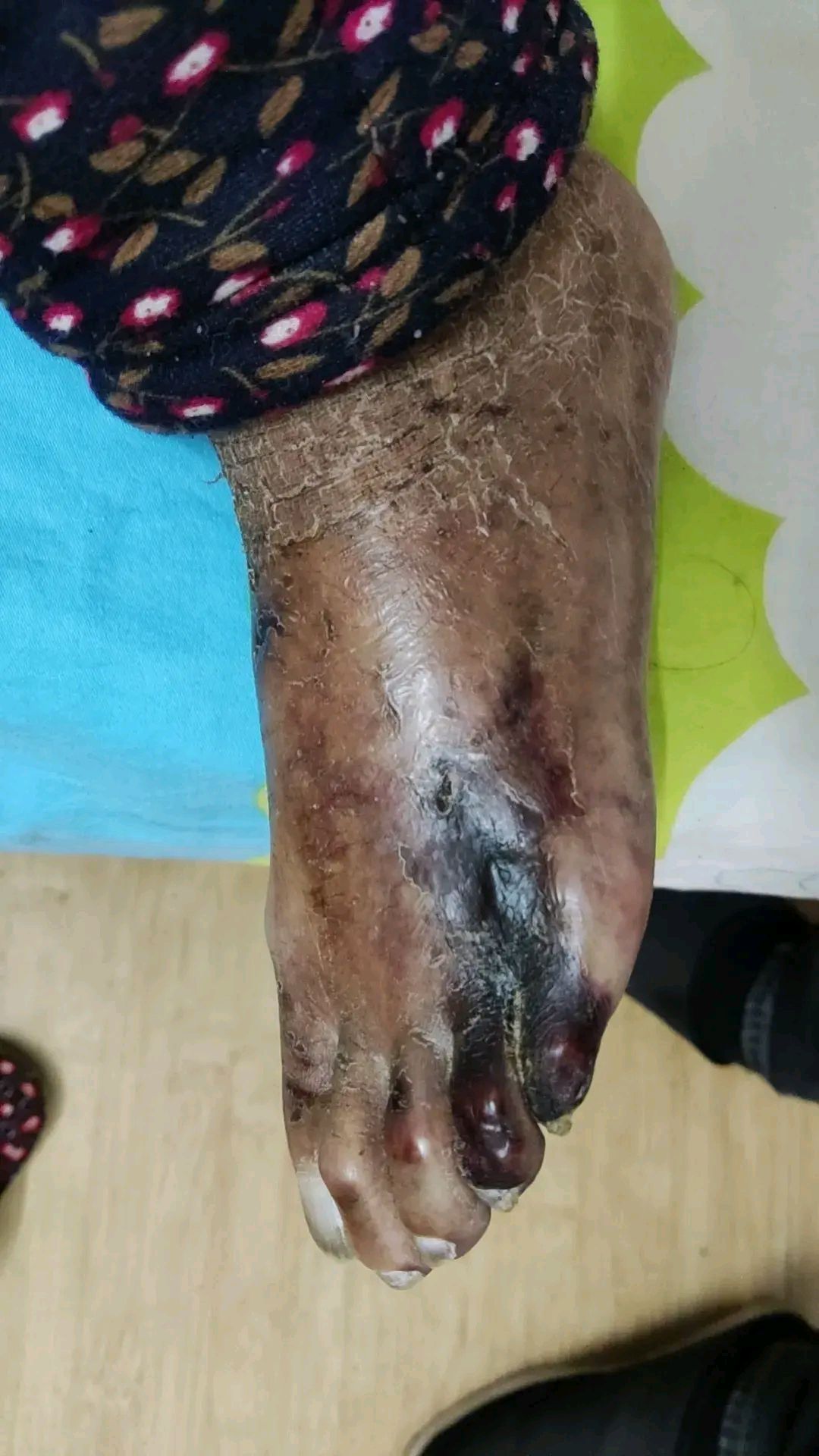 谁能告诉我这是什么原因引起的,老人的脚,八十多岁了,无外伤,跪求