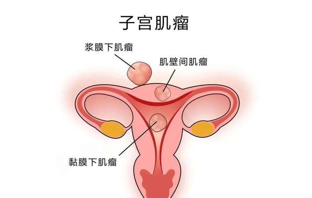 女性为什么容易长子宫肌瘤?医.@虞医生健康说的动态