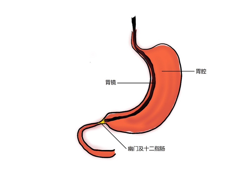 「健康科普之胃镜」什么是胃镜?