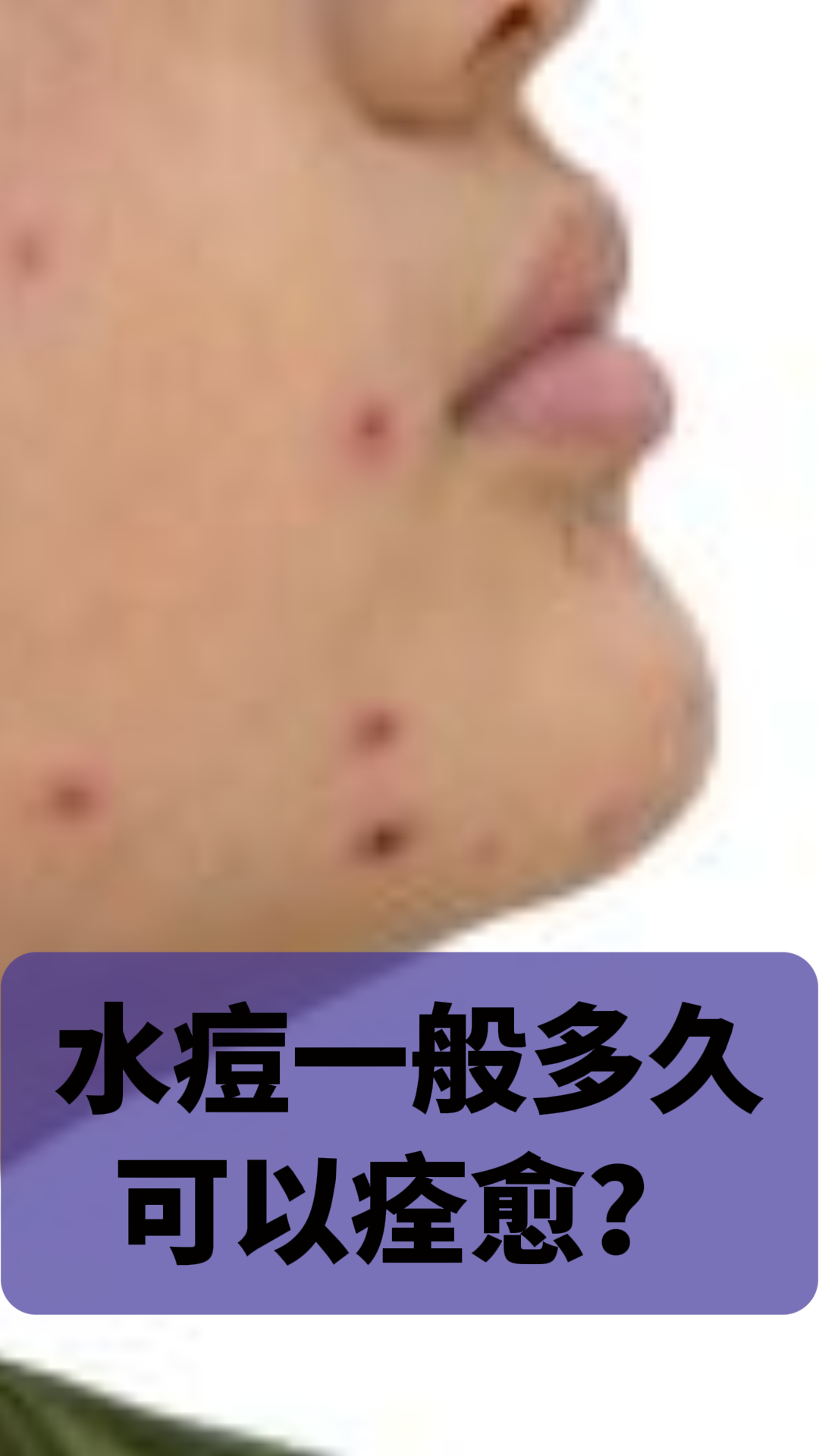 水痘是由水痘-带状疱疹病毒引起的一种传染性疾病,主要发生在儿屯和