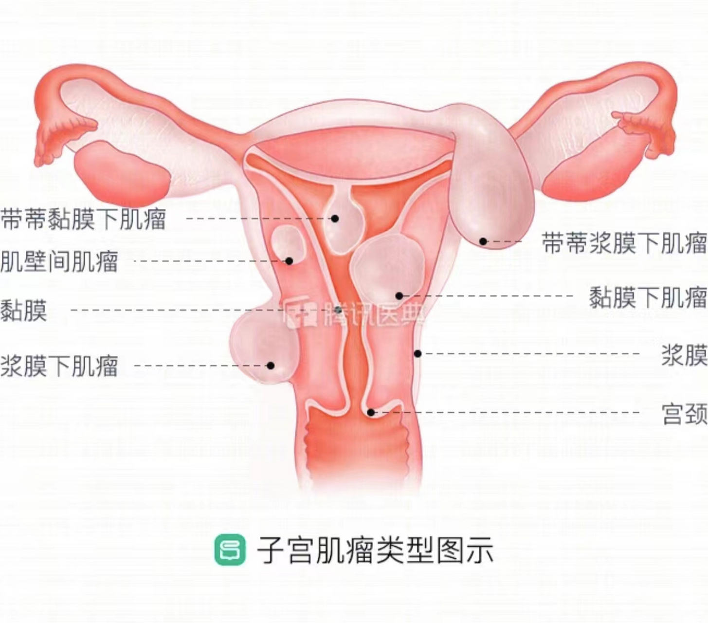 前壁肌壁间子宫肌瘤图图片