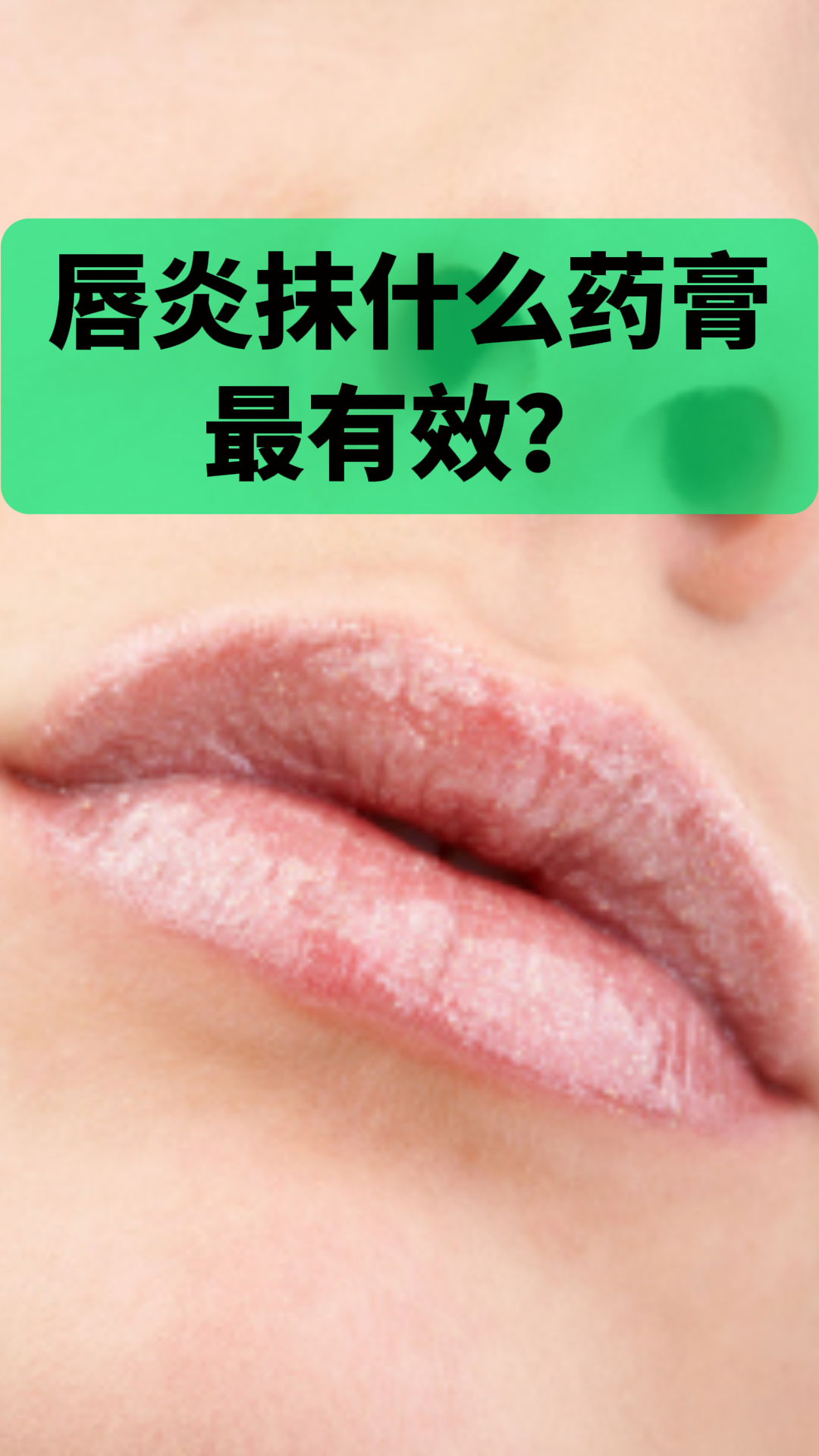 唇炎涂唇膏(唇炎能涂润唇膏吗)
