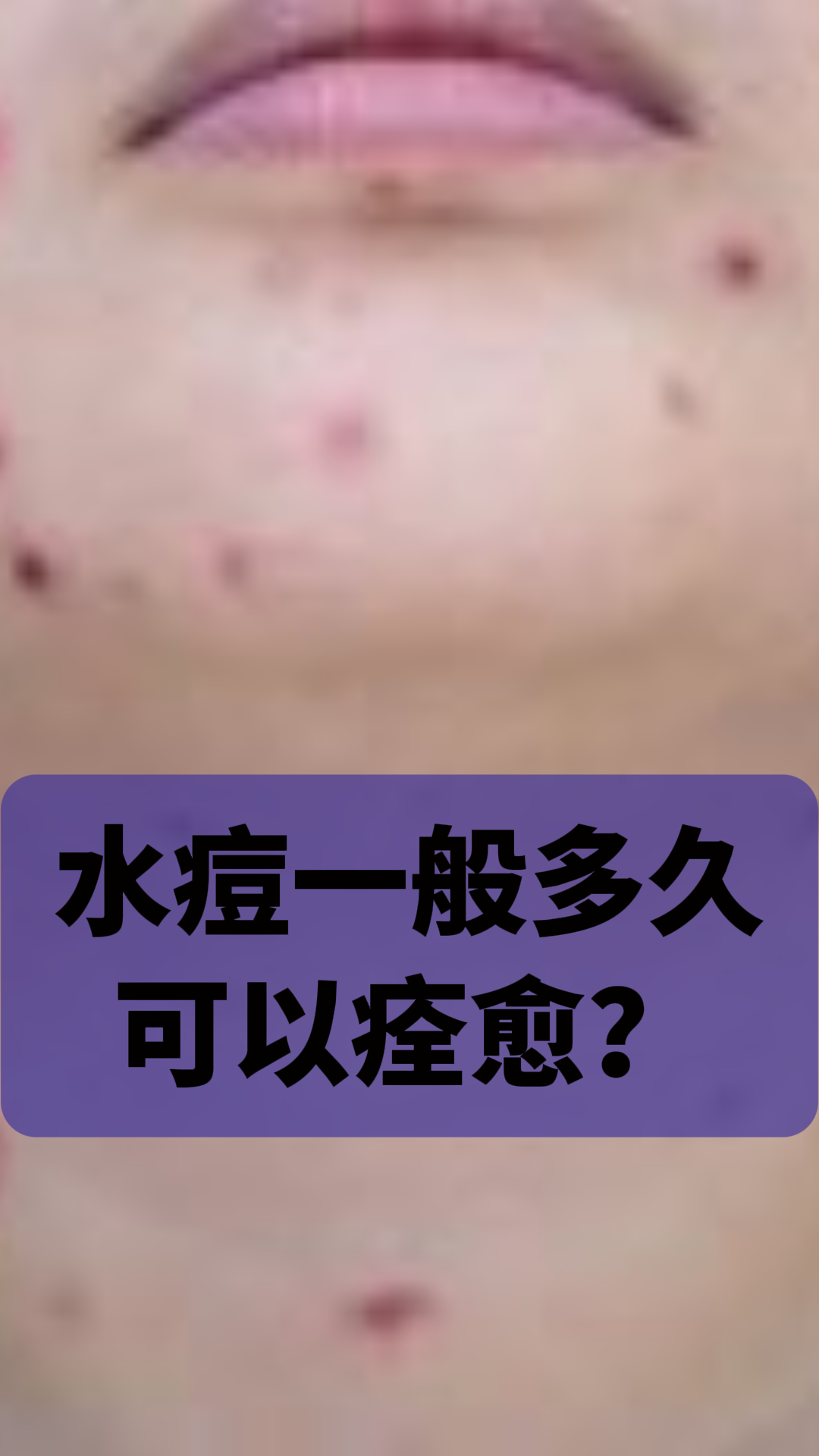 [嘻嘻]水痘一般多久可以痊愈?