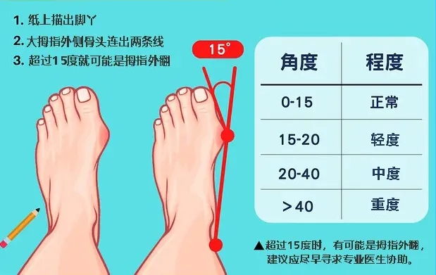 第一跖骨和第二跖骨间的角度(ima>9度的时候,就称为「拇指外翻」