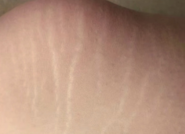 一个年轻的小伙子和他的女友同居后发现女友肚子上有一些银白色的条纹