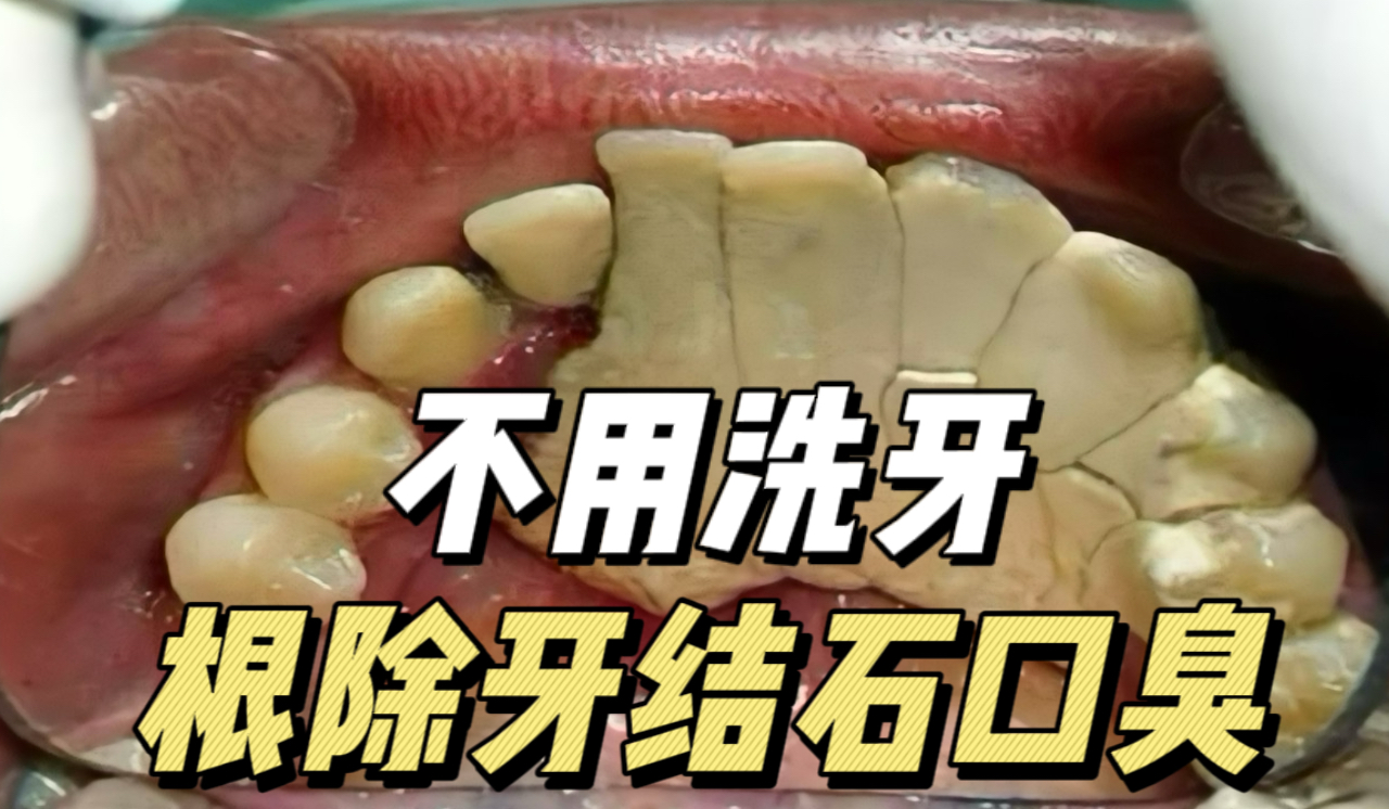牙结石臭味熏天不用去洗牙!掌握三个方法,在家恢复清新口气!