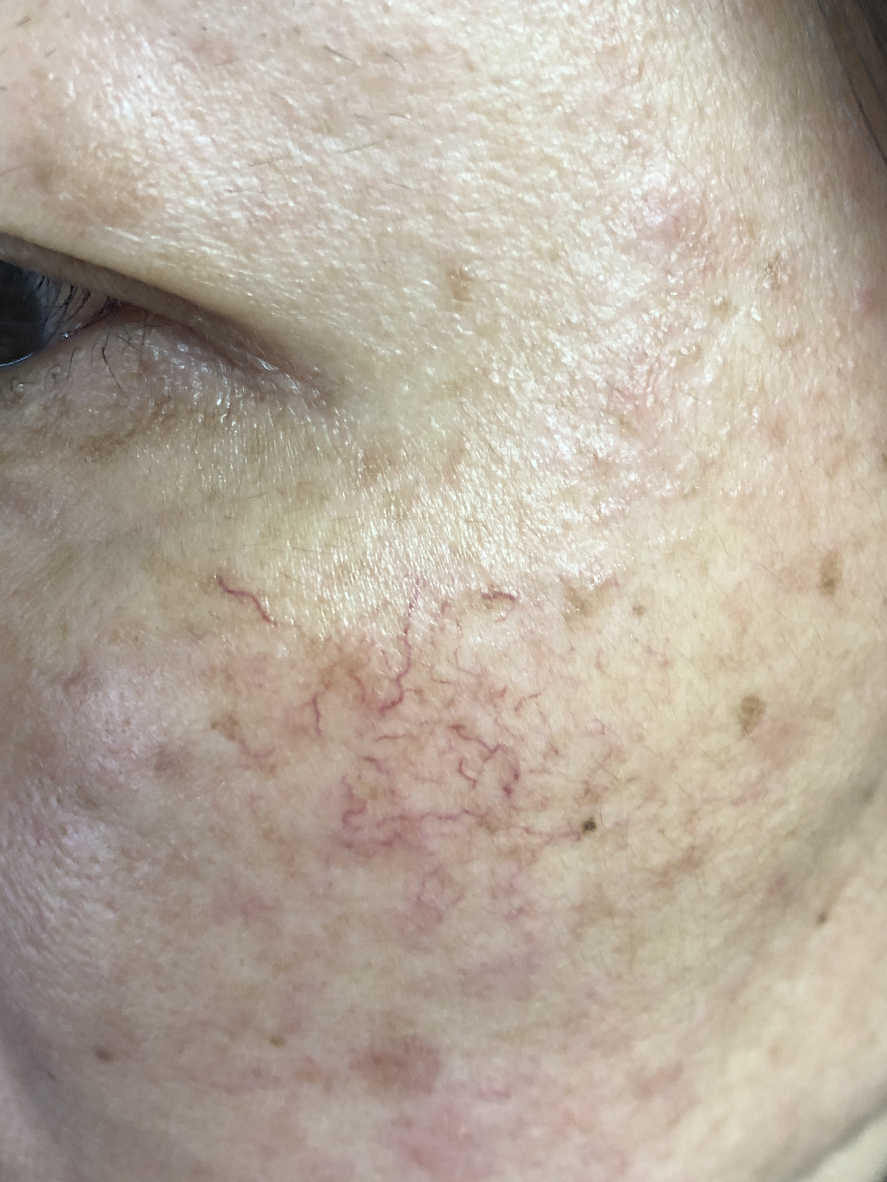 皮肤镜下树枝状血管,这是激素脸的典型表现