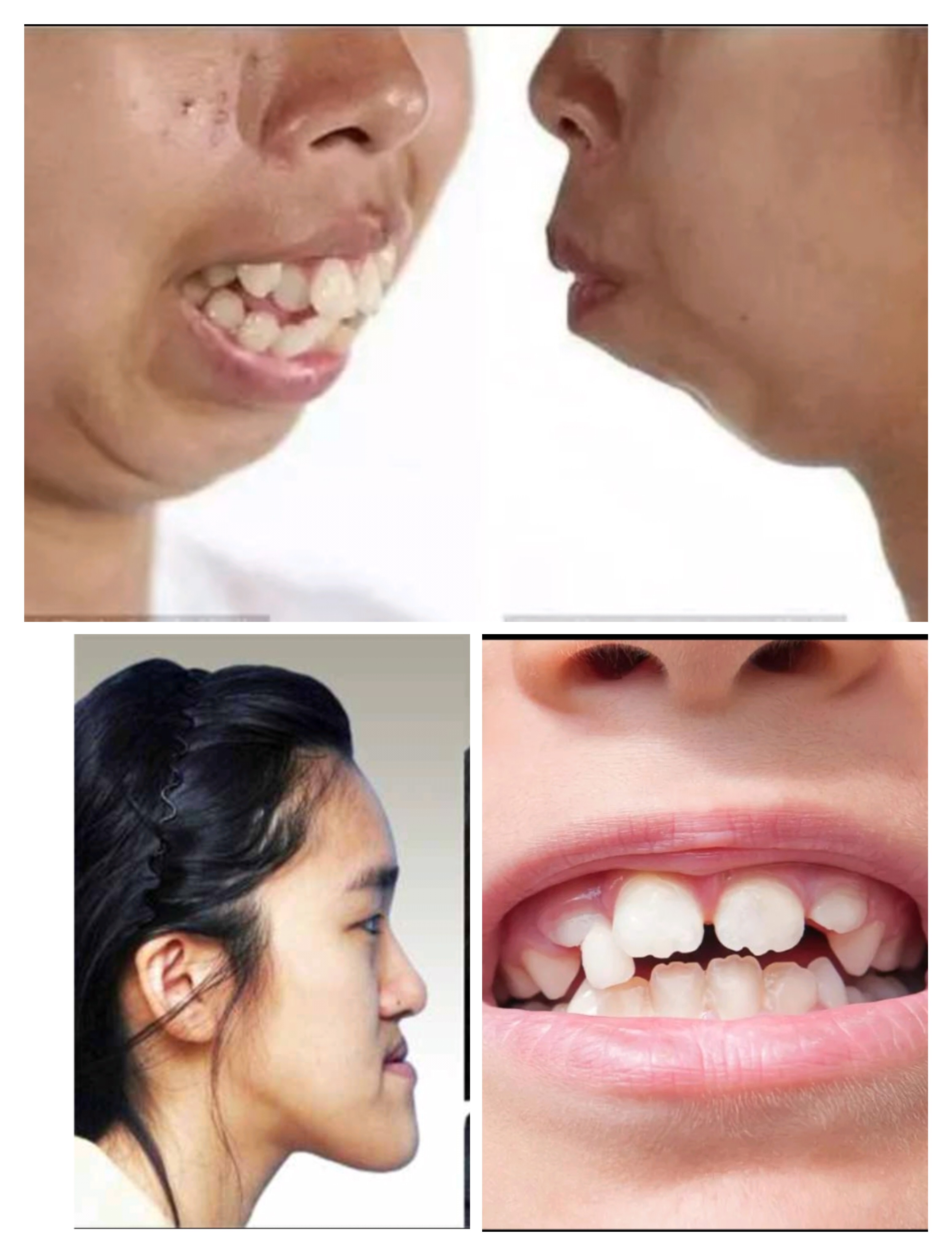 忽视这些可能会导致龅牙,包天,牙裂,不齐等问题,影响孩子一生的颜值.