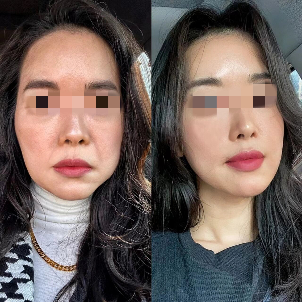 45岁的我做完无痕筋膜提升半年了,这效果怎么样?