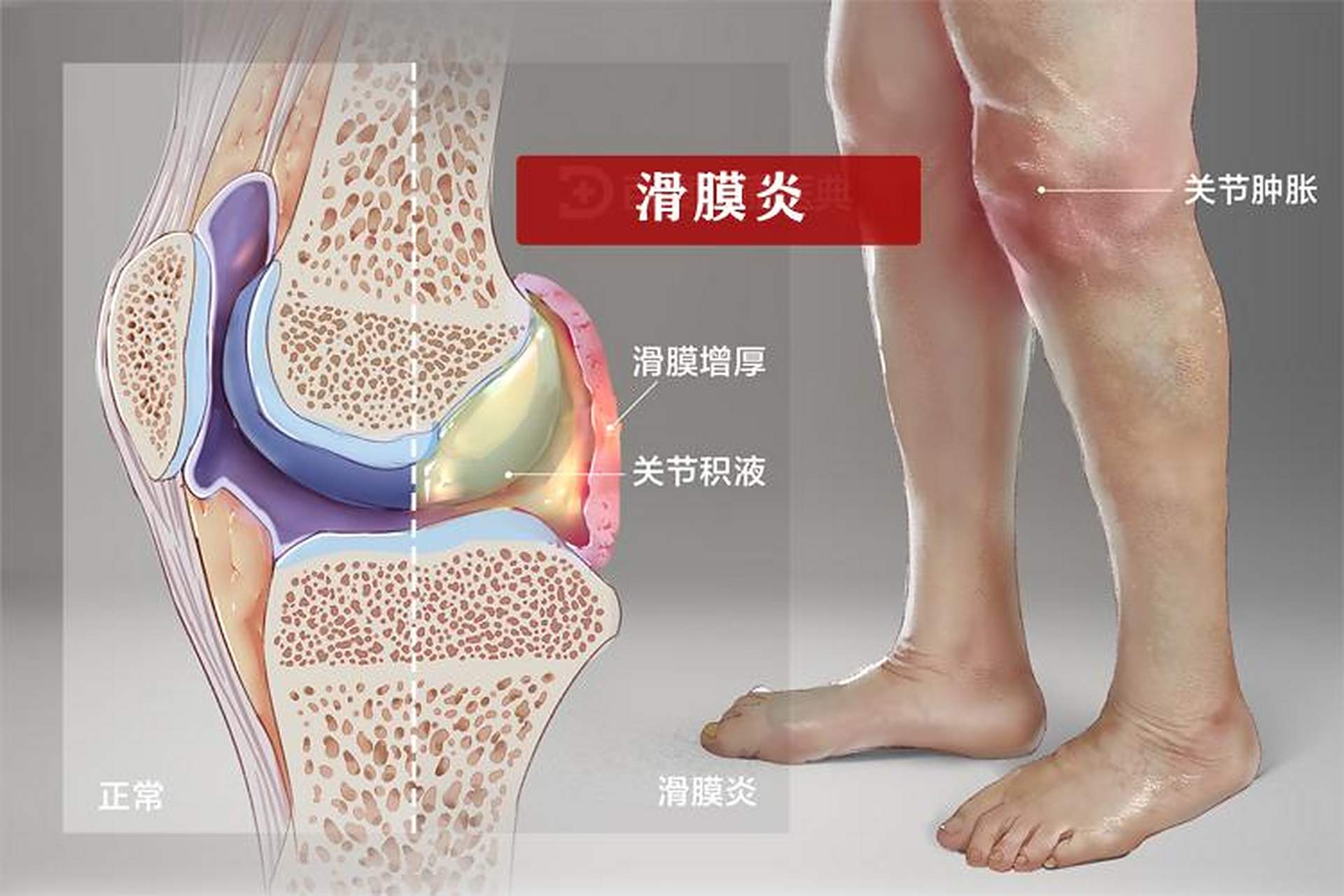 膝盖滑膜炎是膝盖哪个部位疼?