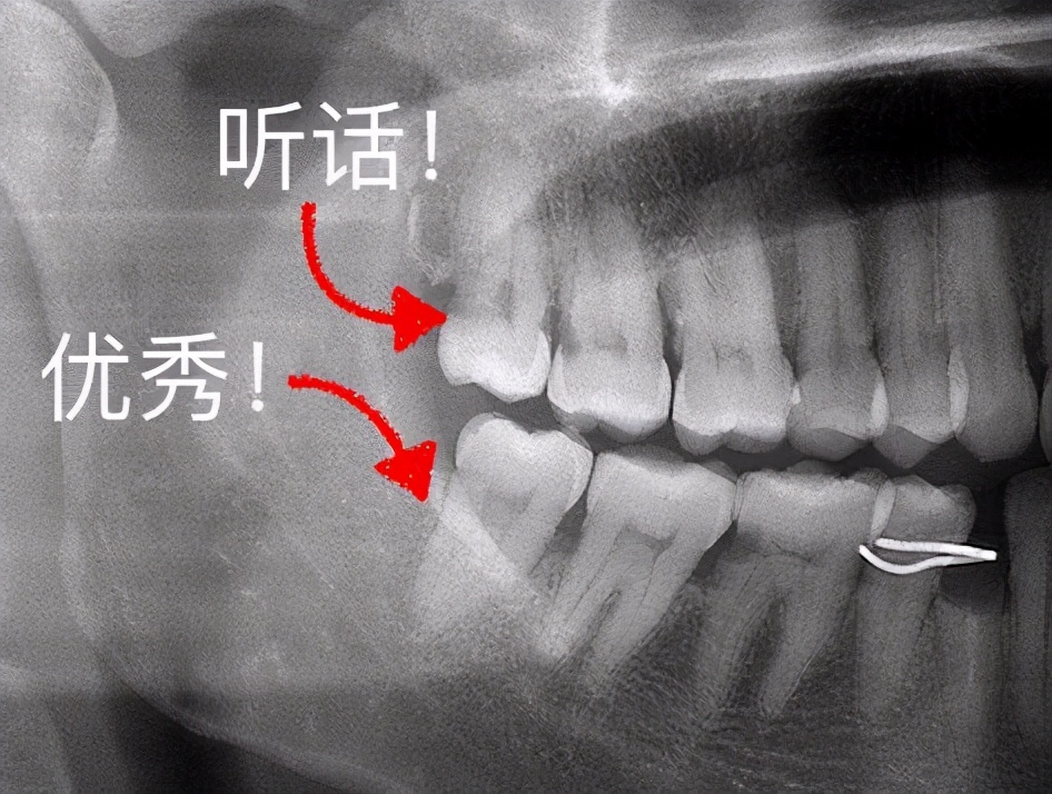 长智齿都要拔吗?牙医 这三种情况可以不拔