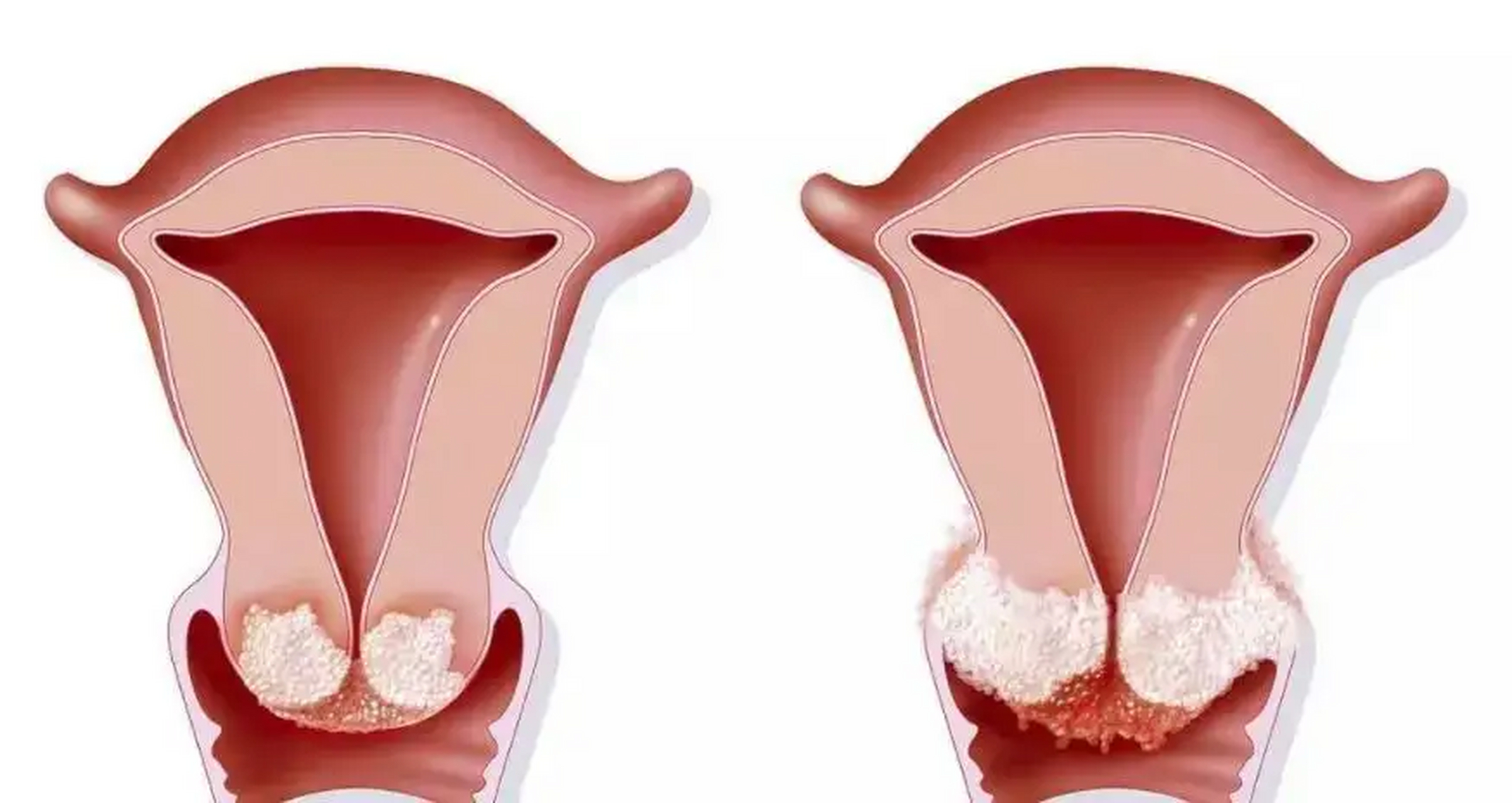女人身体若有3处异常,趁早就医  宫颈癌是一种发生在女性宫颈细胞内的