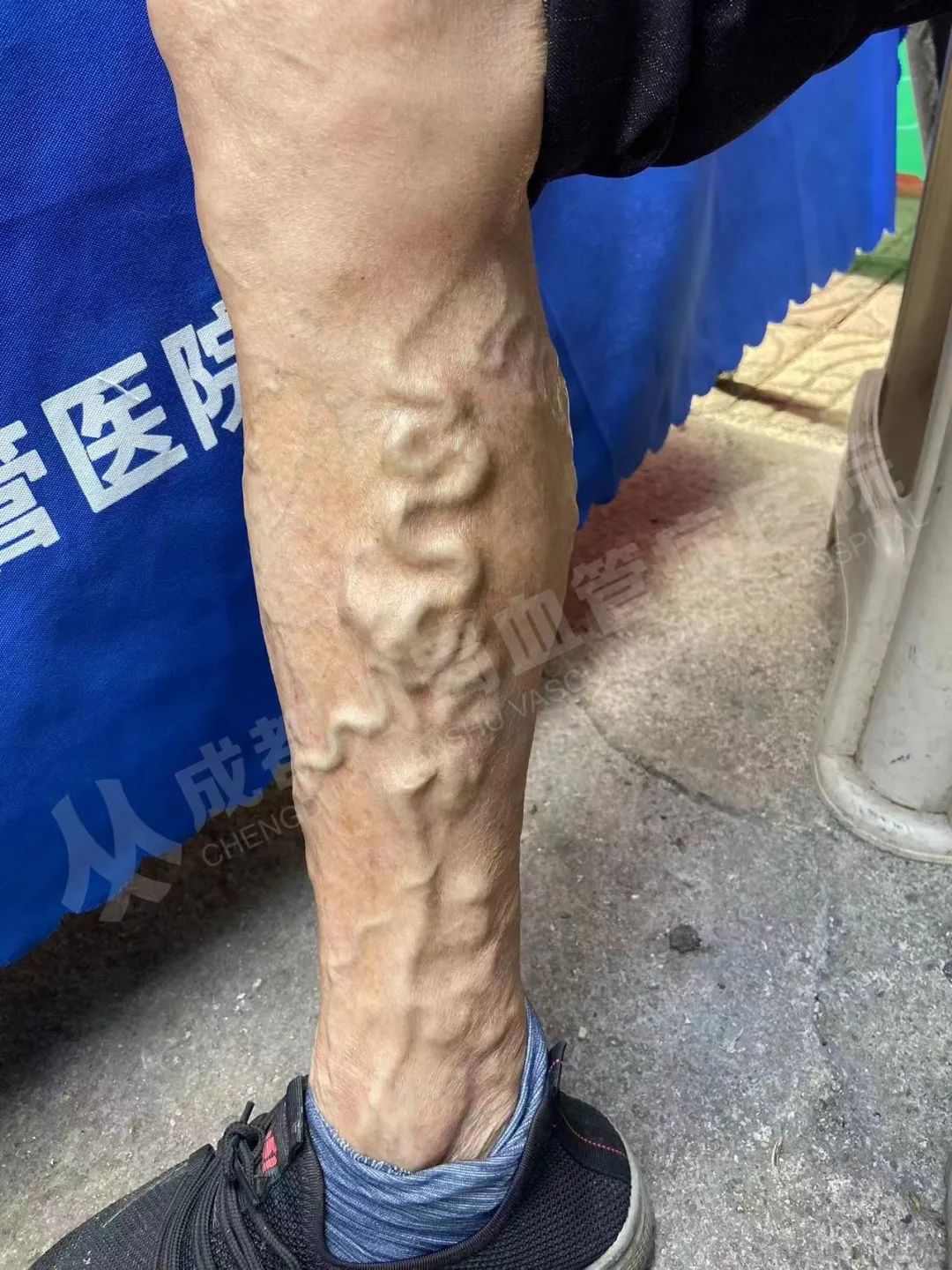 做到这四点,下肢静脉曲张患者再也不愁冬季该如何护理了!