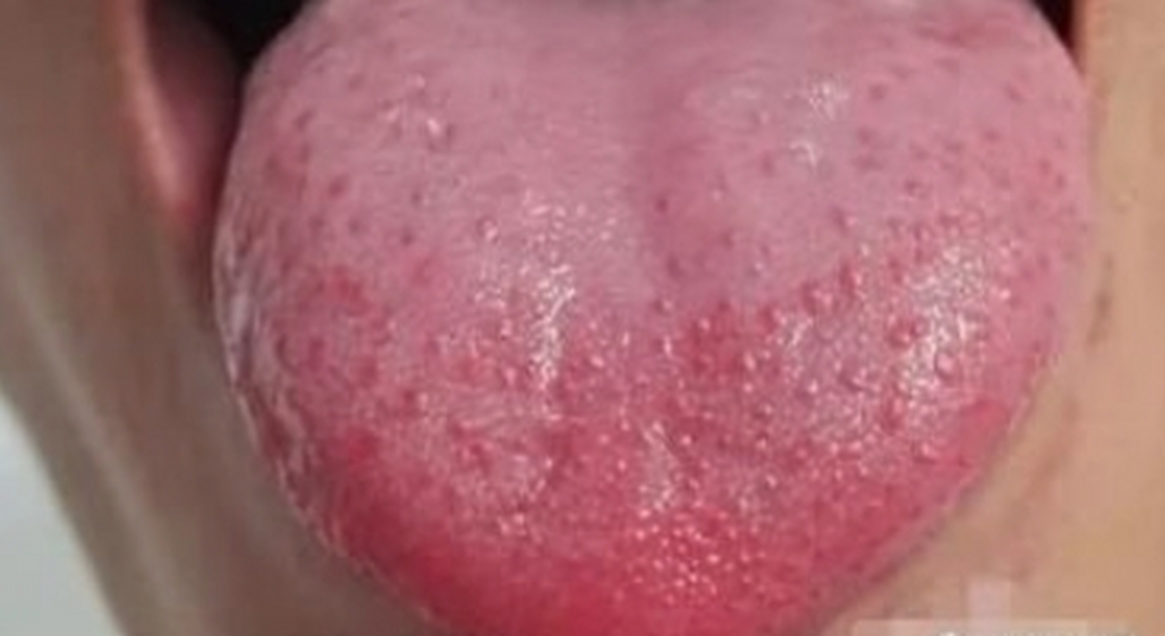 舌象分享之:芒刺舌   芒刺舌是指舌生芒刺 主邪热太盛,为实火 舌尖有