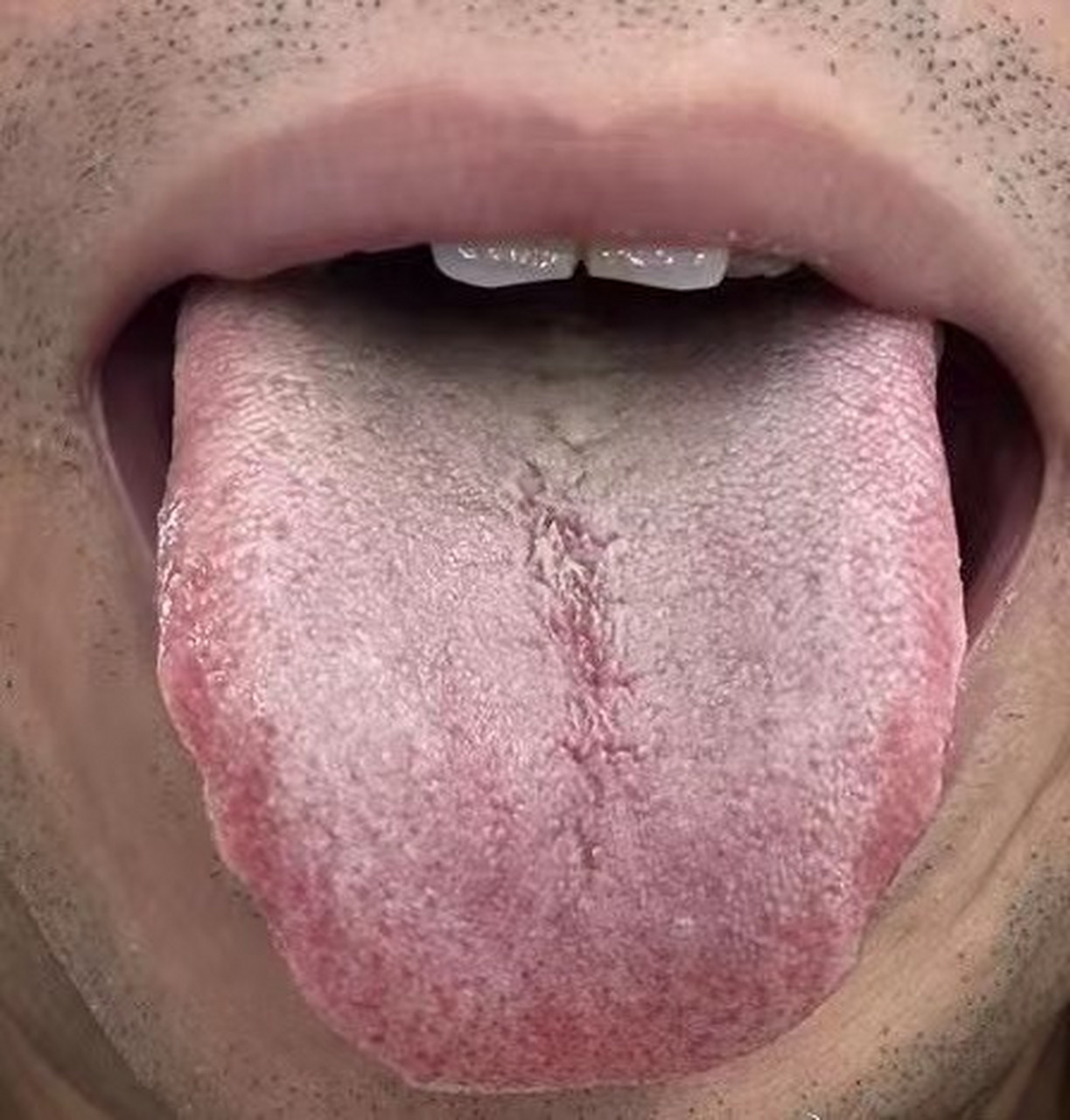 舌面有裂纹,舌根凹陷,这也就30来岁,怎么就成这样了!