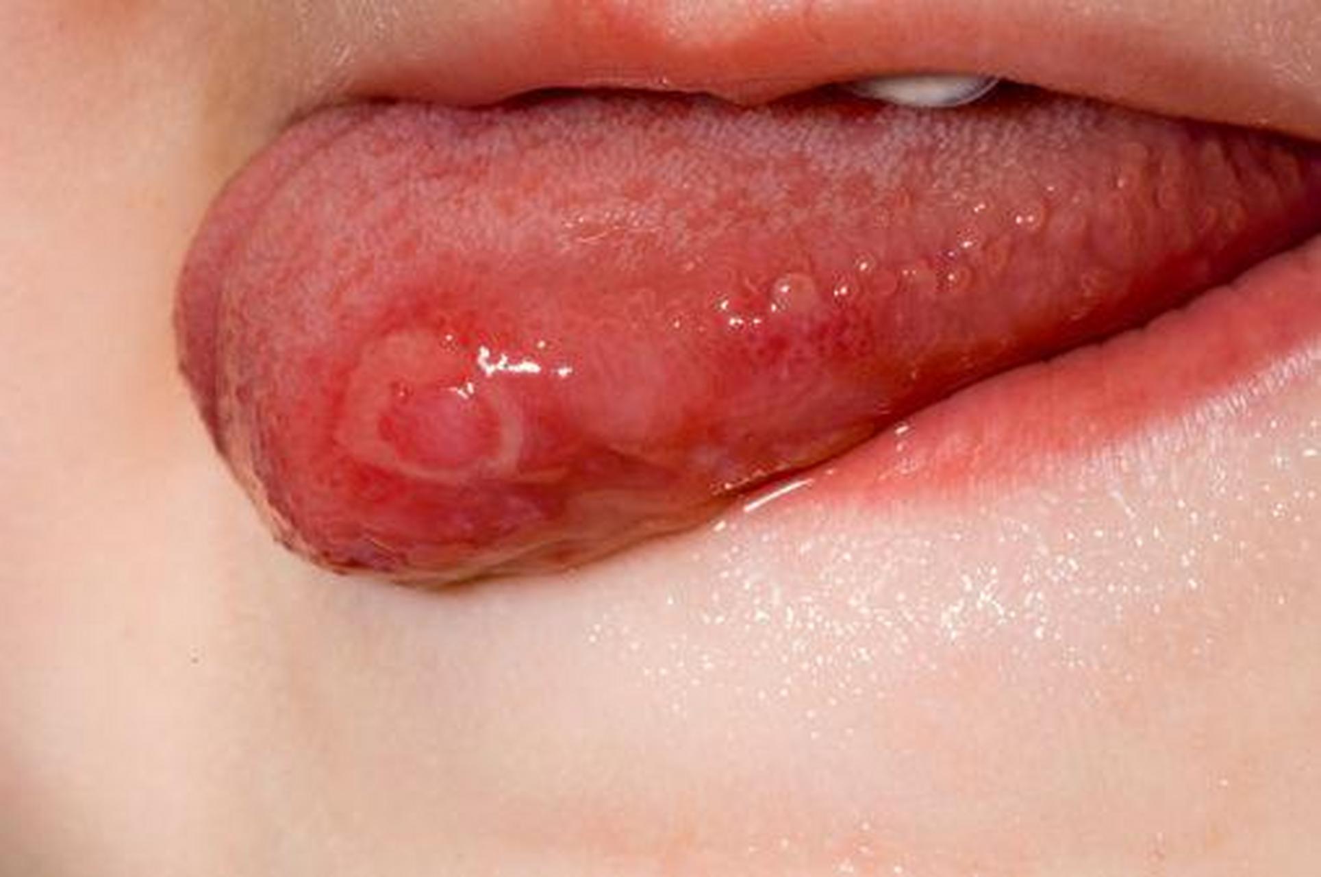 舌头溃疡舌尖图片