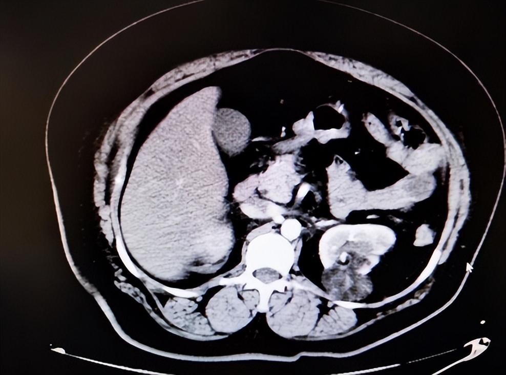 女子左肾长出错构瘤 泌尿外科专家巧施妙招去瘤保肾