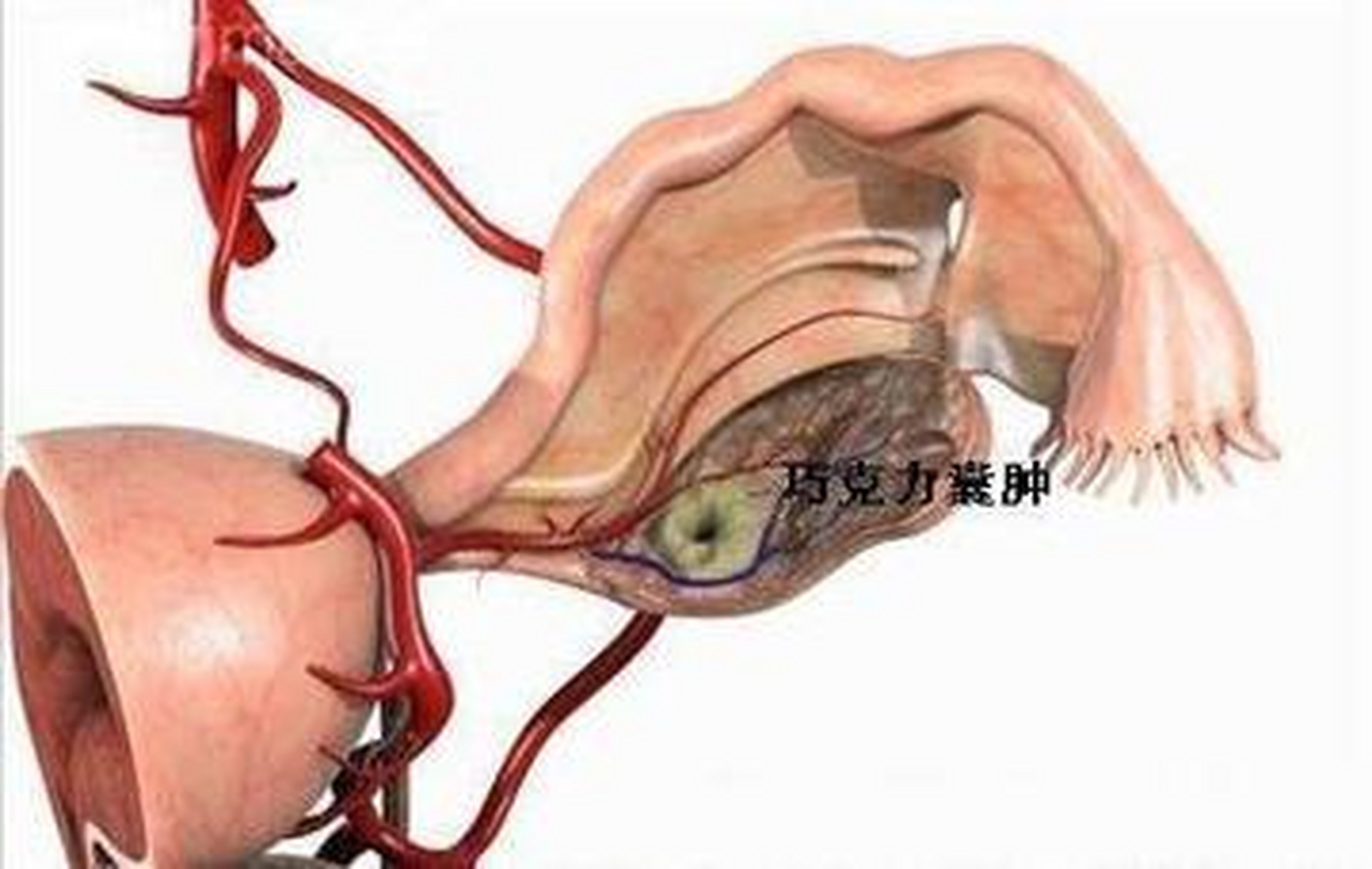 卵巢巧囊图片