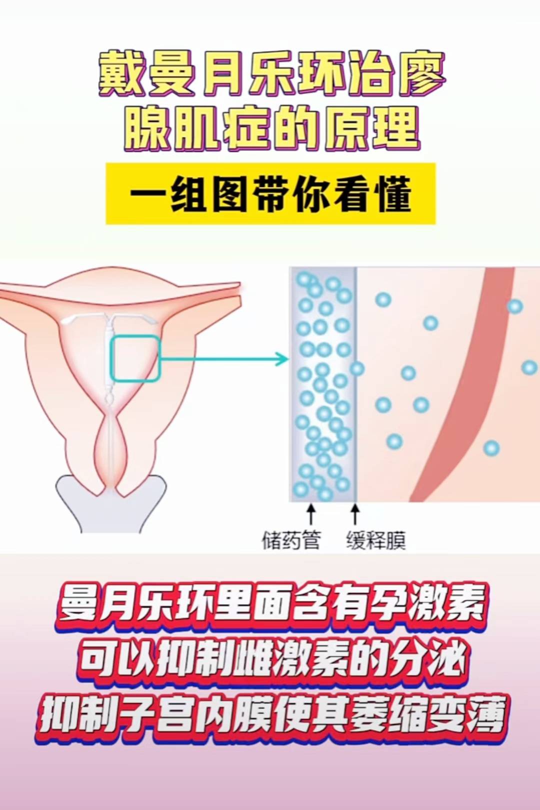 一组图带你看懂,腺肌症戴曼月乐环的原理